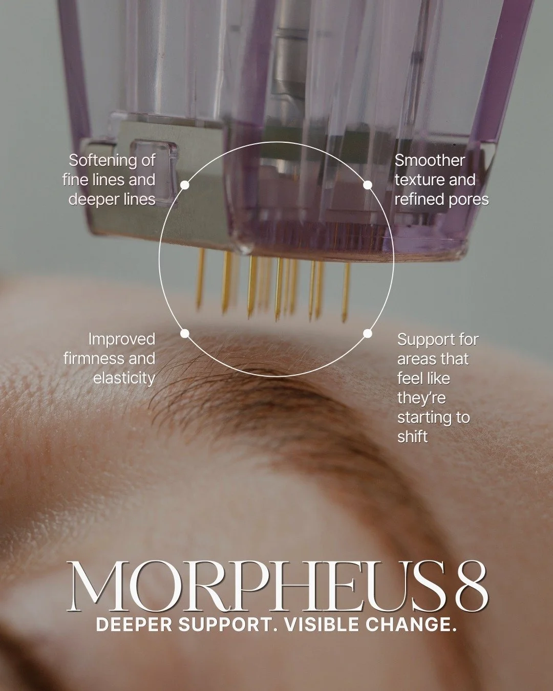 Some treatments refine the surface. Others go deeper.

Morpheus8 works beneath the skin &mdash; combining microneedling with radiofrequency to remodel collagen at a deeper level.

What that means for your skin:

&bull; Improved firmness and elasticit