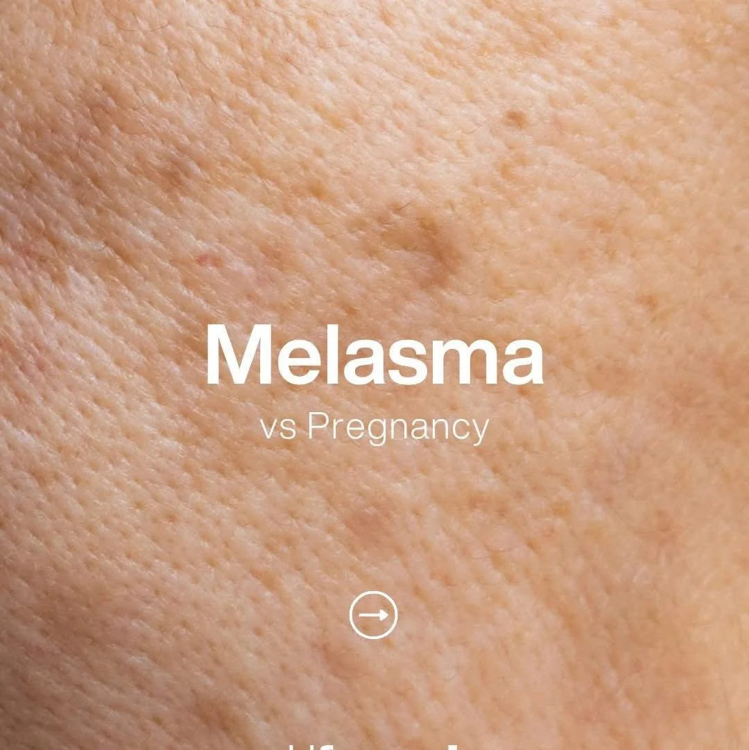 Melasma during pregnancy? 
Melasma during pregnancy is not just pigmentation, it&rsquo;s a hormonally driven response that requires a professional and controlled approach.

👩🏼&zwj;🔬 Contact your nearest pHformula Skin Specialist to learn more or b