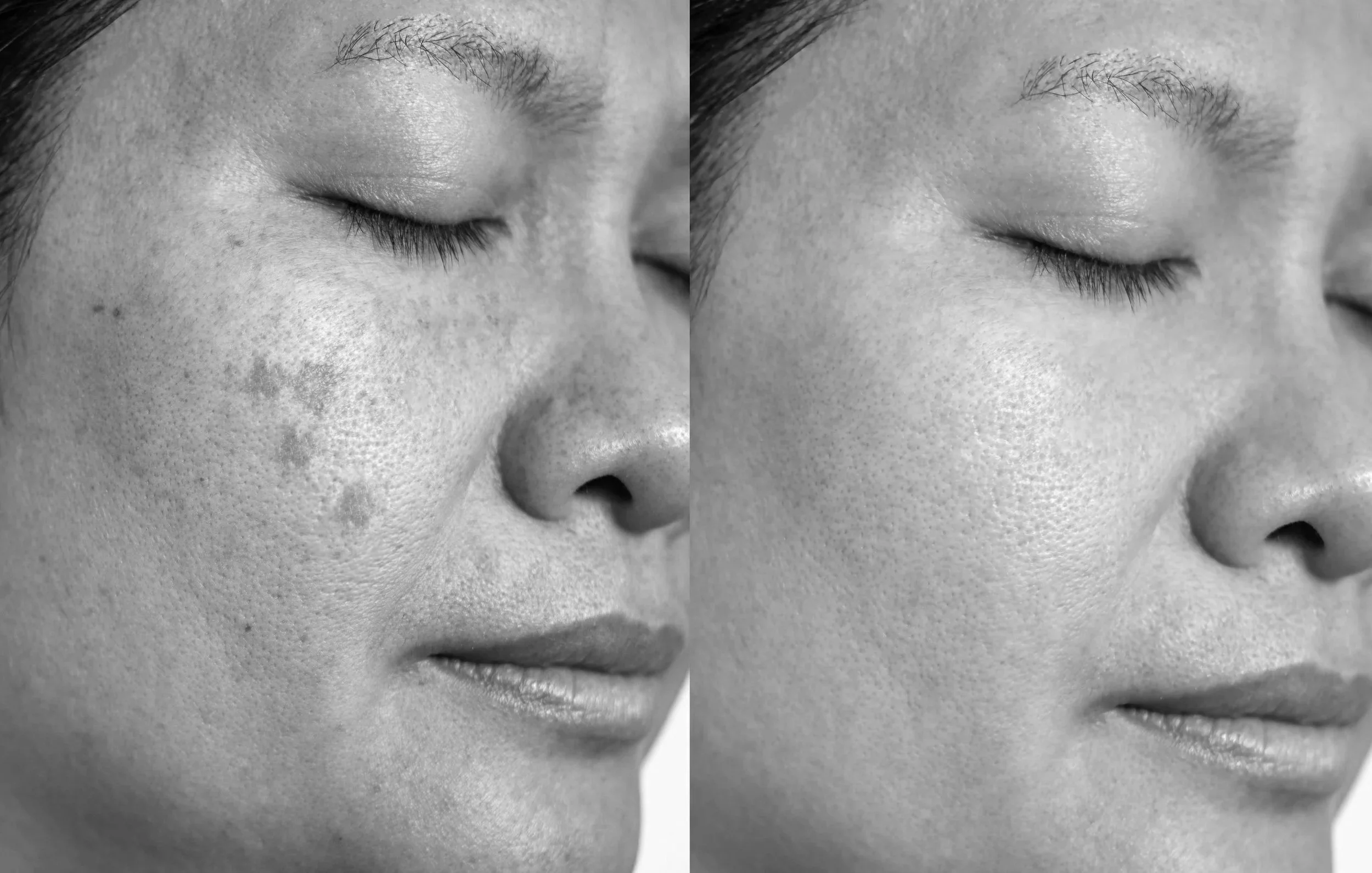 Comparison of a woman's face showing skin blemishes on the left and clear skin on the right, highlighting skin improvement.
