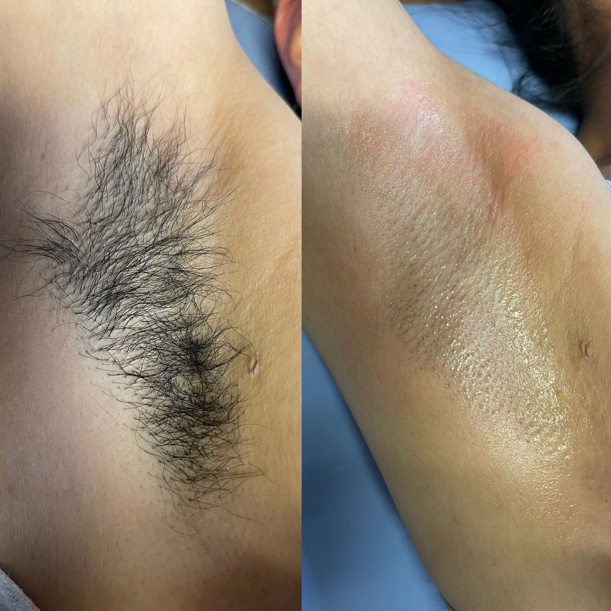 Before and after photo of an african americans underam before and after a sugar hair removal service.