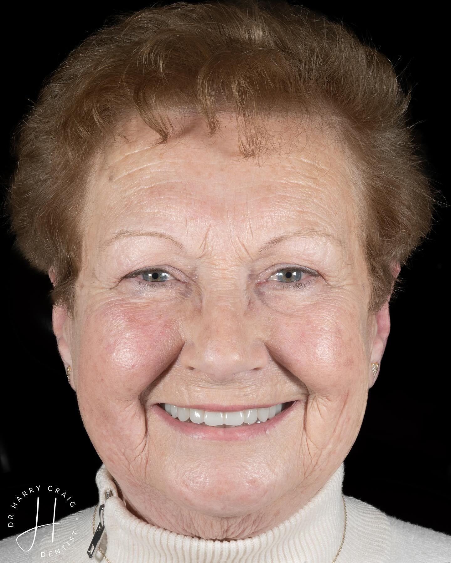 Patients often ask why we do what we do. For me it&rsquo;s cases like this. 🔥 It also couldn&rsquo;t have happened for a nicer patient- this lady is incredible. 

Our lovely patient attended in April last year wanting to make a smile improvement. Sh
