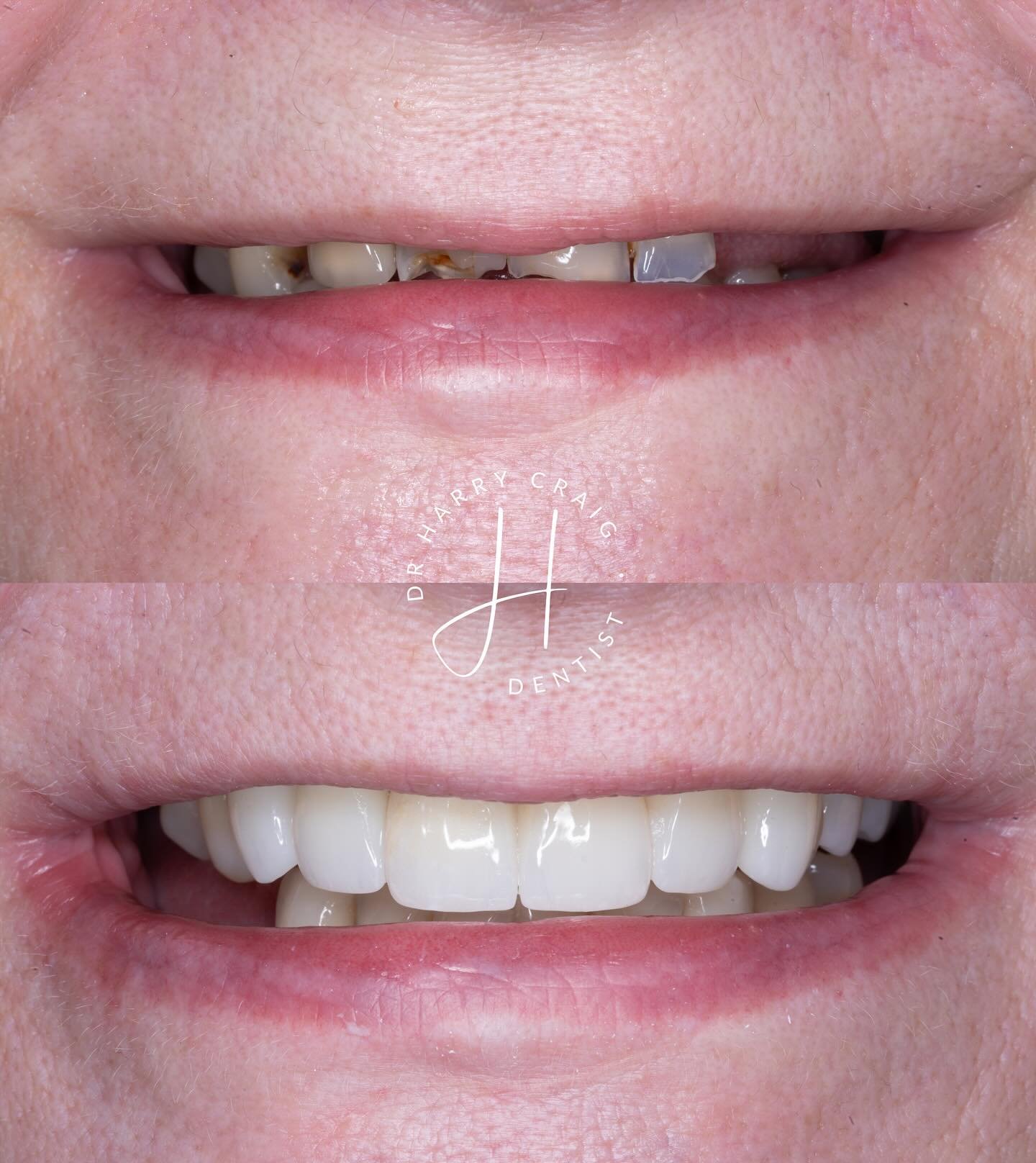 Shot on ring flash&hellip; sorry but I still wanted to share 😂

Seeing results like this reminds me why we do the job. I&rsquo;d say this is probably the most difficult restorative case I&rsquo;ve completed to date. Following @koiscenter principles 