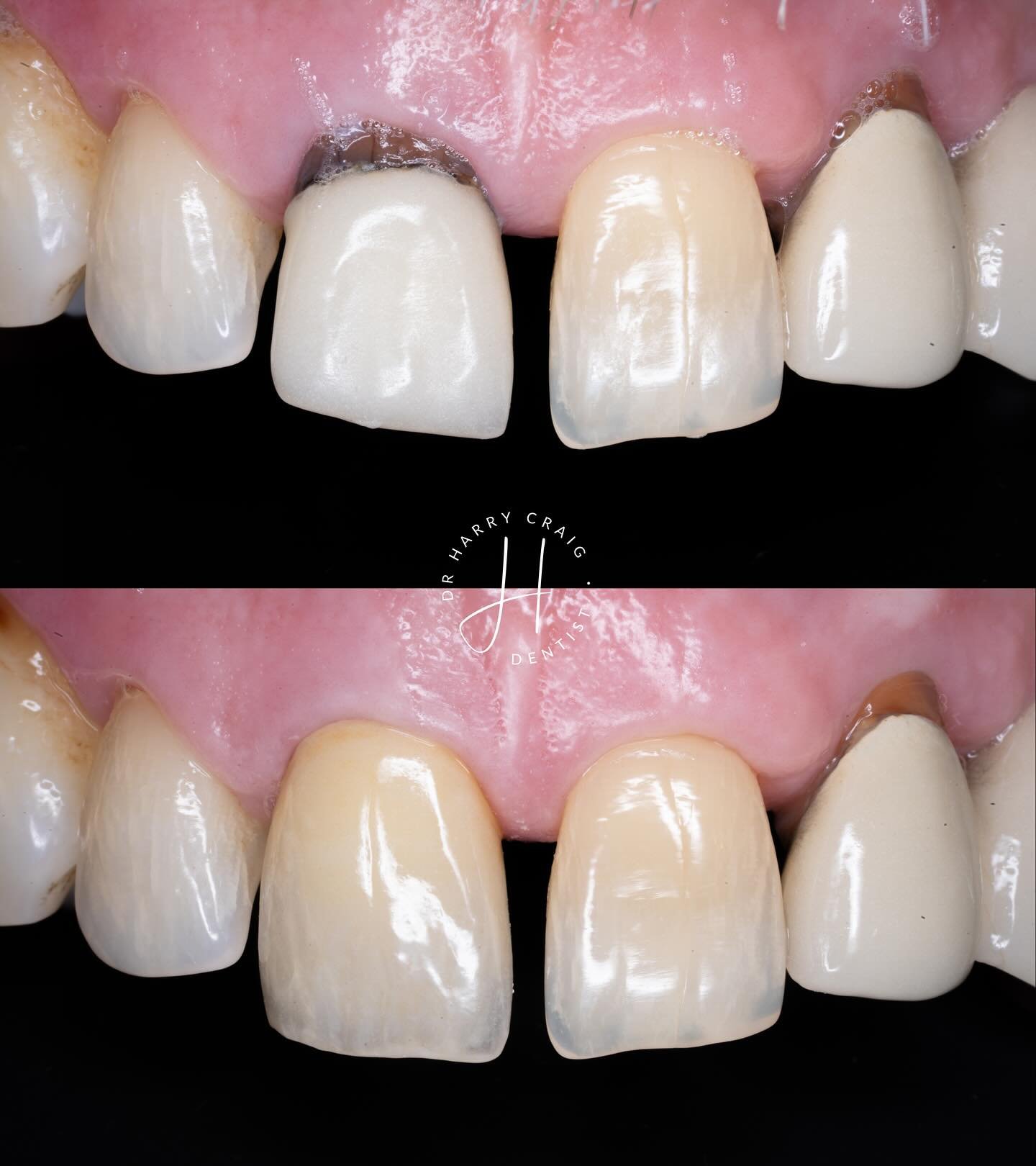 Argh the single central&hellip; 😬😬

So happy to be able to finally post this case! This was one of those oh god how do I manage this cases. We discussed so many options including removal and implant/bridge however the patient was super keen to keep