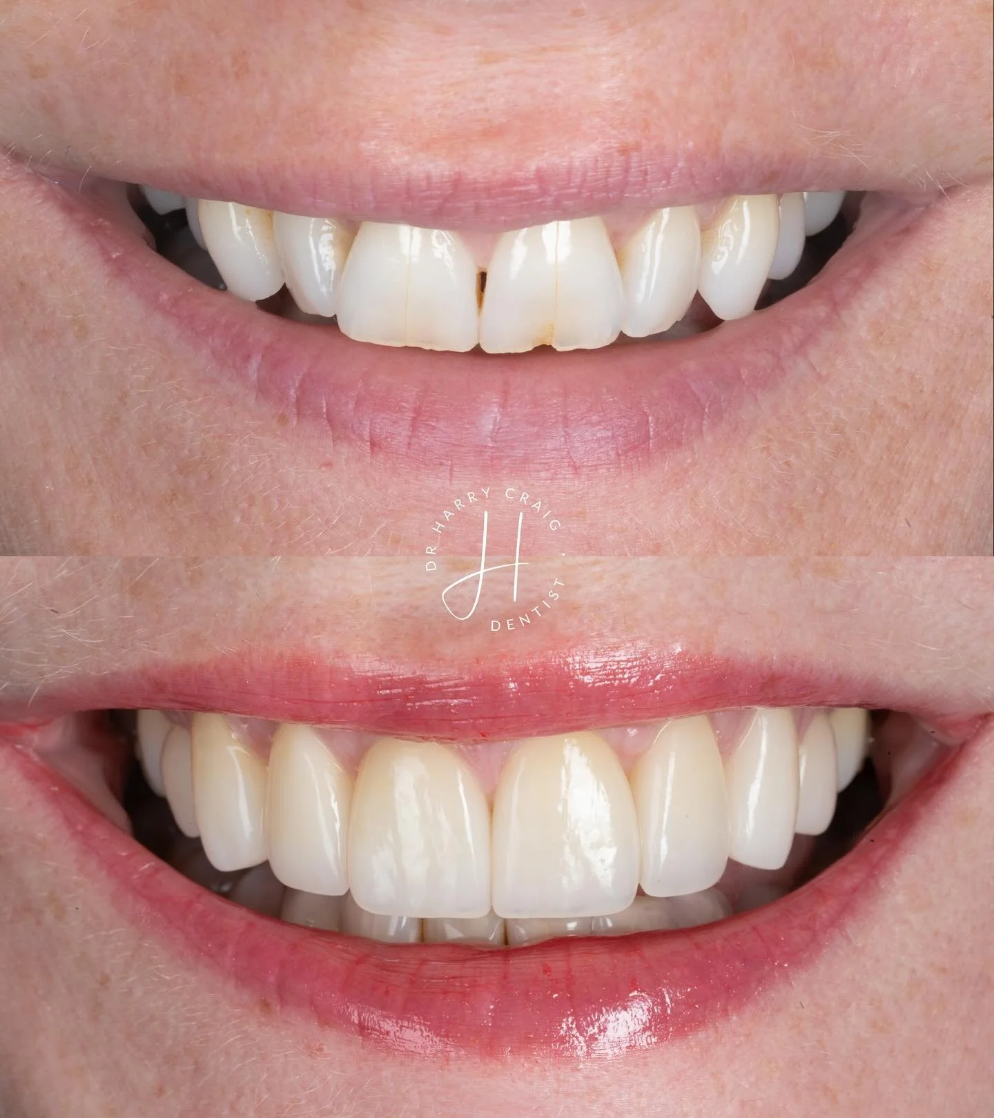 Makeover 🤩

Really happy to share this result for our patient and discuss the accreditation journey as this was my first attempt at a case type 1 - full makeover. Especially as I feel instagram only highlights everyone&rsquo;s successes. 

As I&rsqu