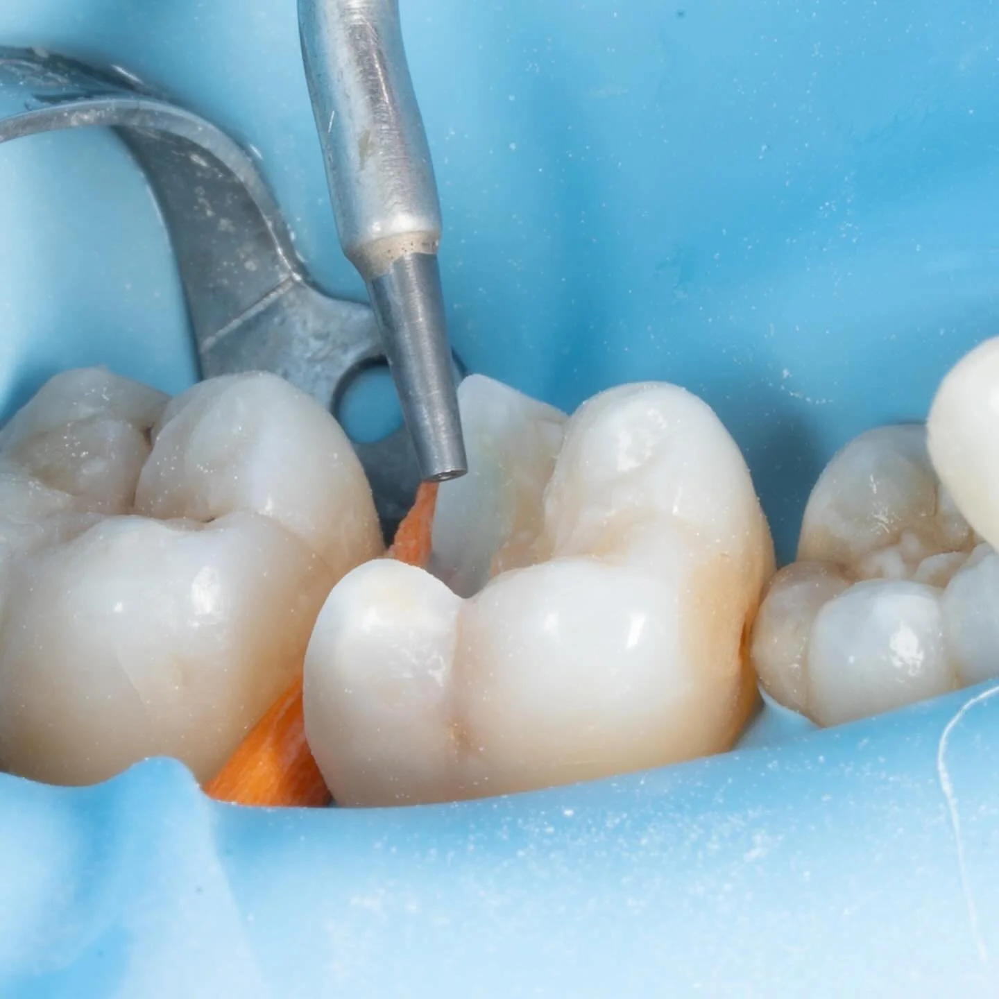 I had the pleasure of lecturing at the @voco.dental @voco.uk @thebacd track day yesterday at Mercedes Benz world. 

I was one of the first dentists in the UK to try their new MTA VPT Liner. This case shows its use as an indirect liner in a deep class