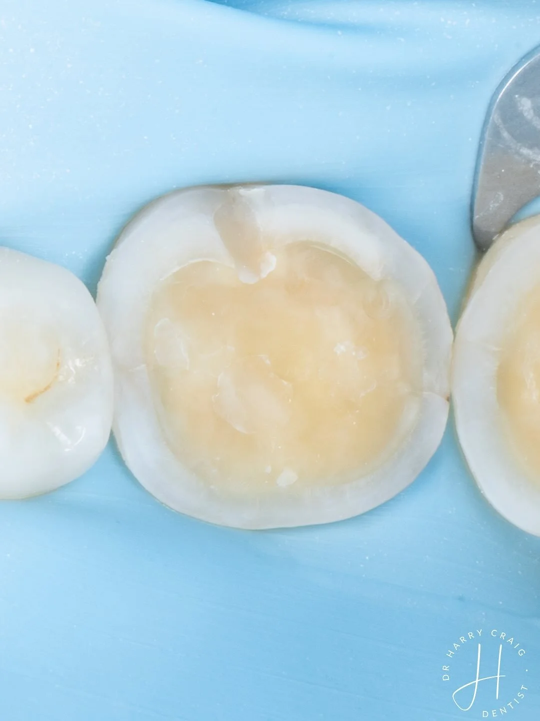 Ceramic Conversion 

This patient had a composite equilibration by addition approx 5 years ago. With time we see the cusps start to blunt again as the composite wears. If left the risk is that the OVD gets less which may cause further anterior wear/f