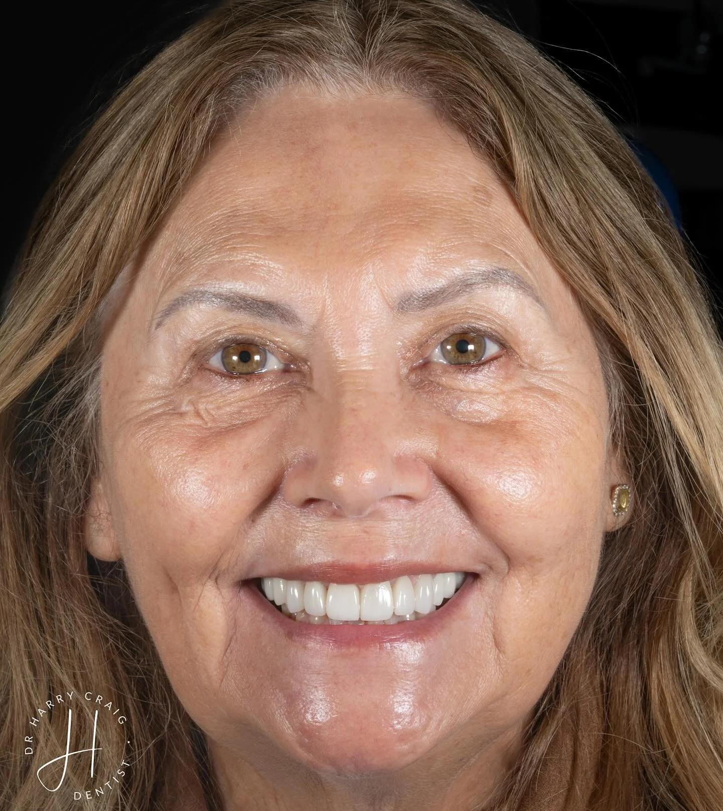 Refresh. 

The cool thing about this, these veneers were placed at the practice nearly 30 years ago. If anything I think it highlights that good quality dentistry lasts. I&rsquo;d quite like to write this case up as I&rsquo;ve managed to find the ori