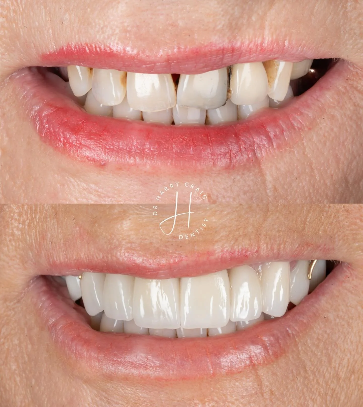 To save or not to save&hellip;

Treatment planning is always hard. As the saying goes give this case to 5 dentists and get 10 plans. 

This was a toughie because I was unsure whether to save these mobile uppers. The UR1 in particular was not ideal as