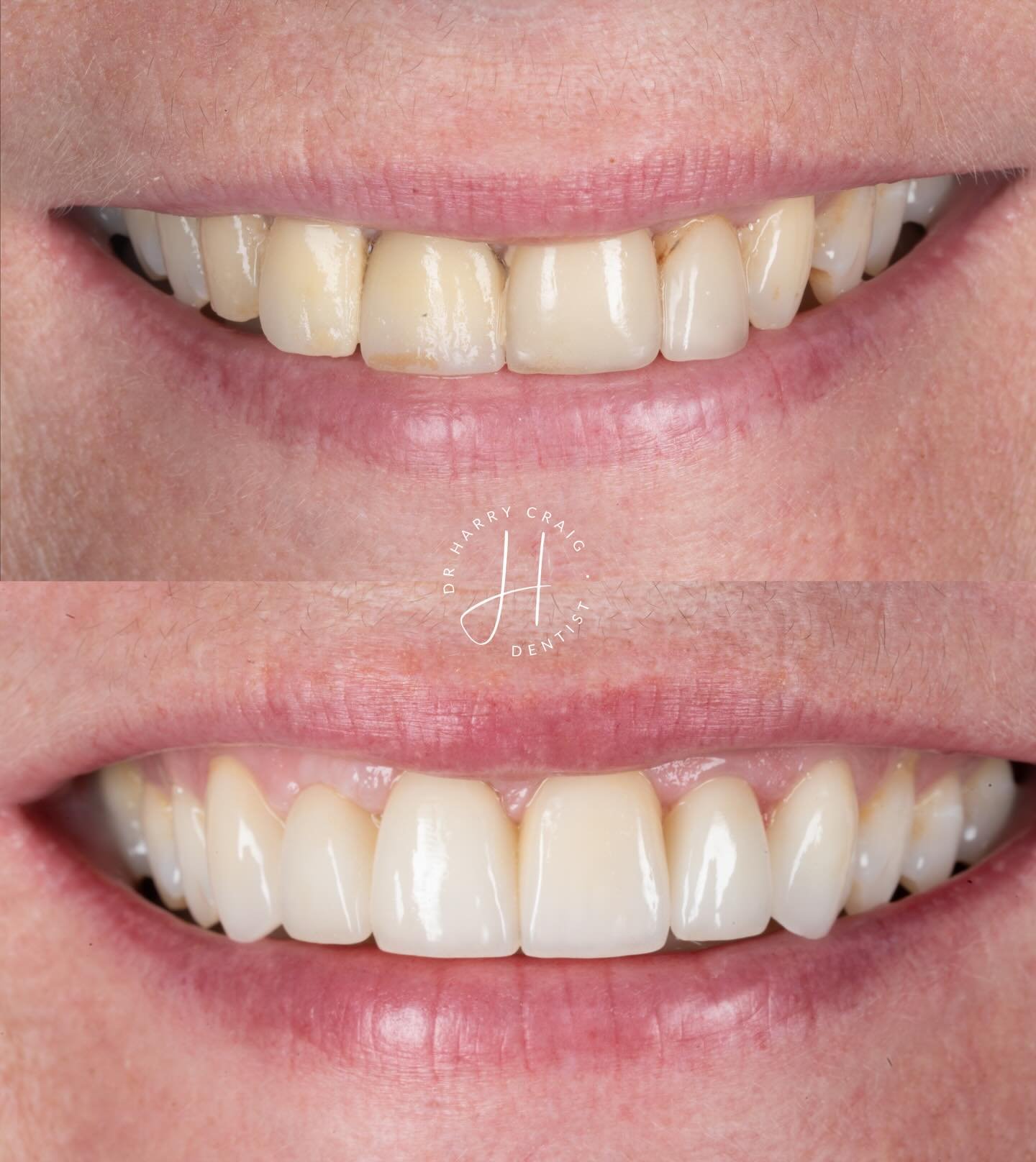 A new bridge for this lovely patient! Ovate pontics developed with the temporary&rsquo;s for a natural appearance. Hopefully further healing to complete around UR1. 
Beautiful ceramic work by Frontier as always 🏆