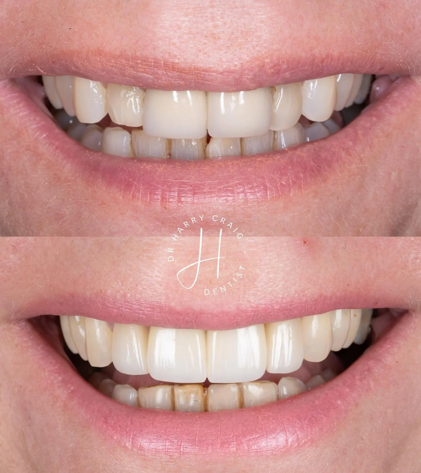 A closer view of last weeks case! 

I still can&rsquo;t believe how dark the stumps were when the crowns came off. A very difficult case to manage but supper happy to achieve this result in a challenging case. 

A couple of you reached out to ask how