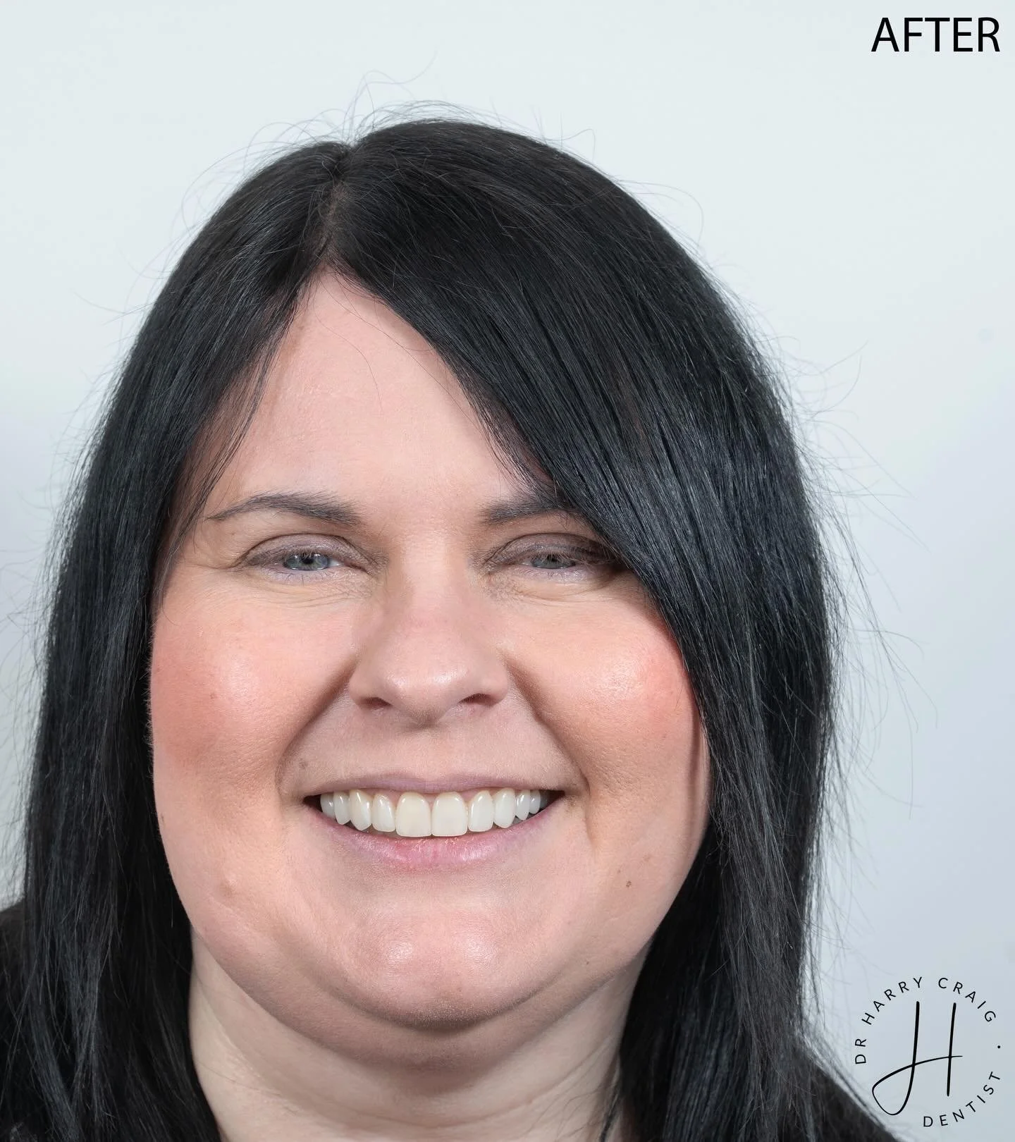 As a 23 year old dental graduate, did I think I&rsquo;d be doing this type of dentistry within 5 years&hellip; probably not. What I did want to do was invest in education and strive for excellence. There is still a long way to go but I am particularl