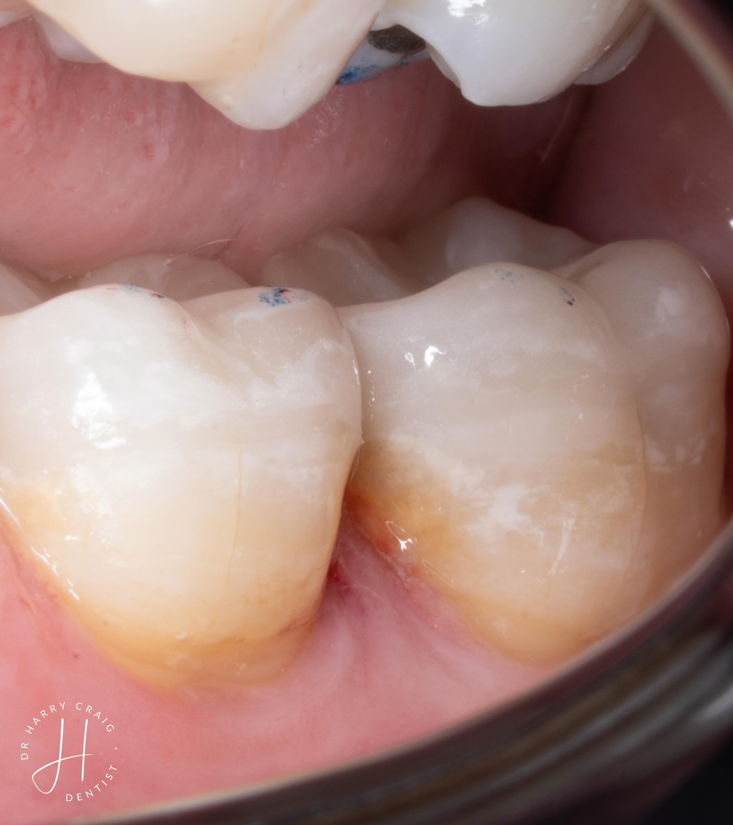 I feel I&rsquo;ve been neglecting the posterior posts recently&hellip; that being said like most of you all it still forms a significant mainstay of my practice! 

People often ask how do I decide whether to onlay or go for a crown. I follow the rule
