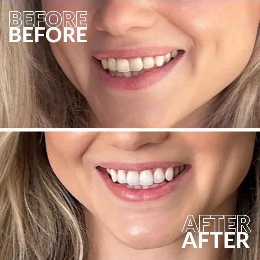 Close-up of a woman's smile before and after teeth whitening, showing whiter and brighter teeth in the after image.