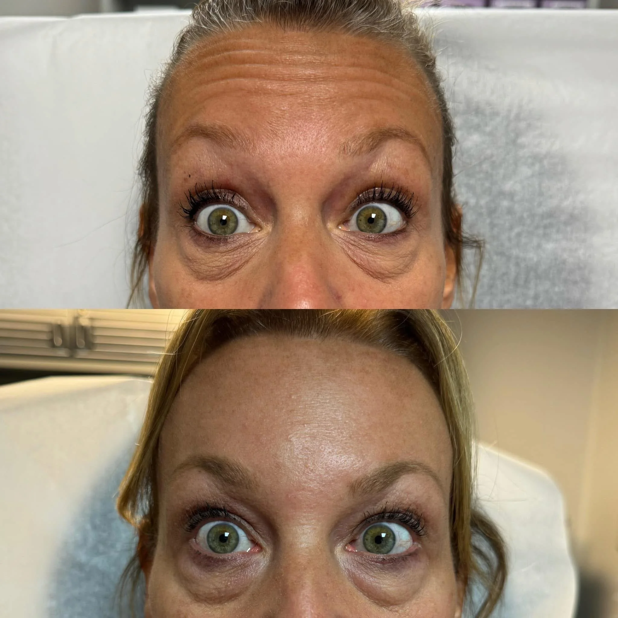 Close-up of a woman's face before and after a cosmetic treatment, showing reduced under-eye puffiness and wrinkles.