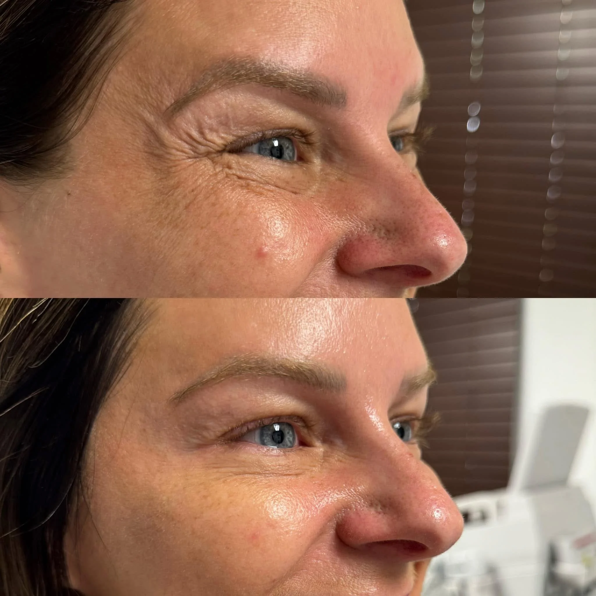Close-up side-by-side images of a woman's face showing improvements in skin texture and appearance, focusing on eye and cheek area.