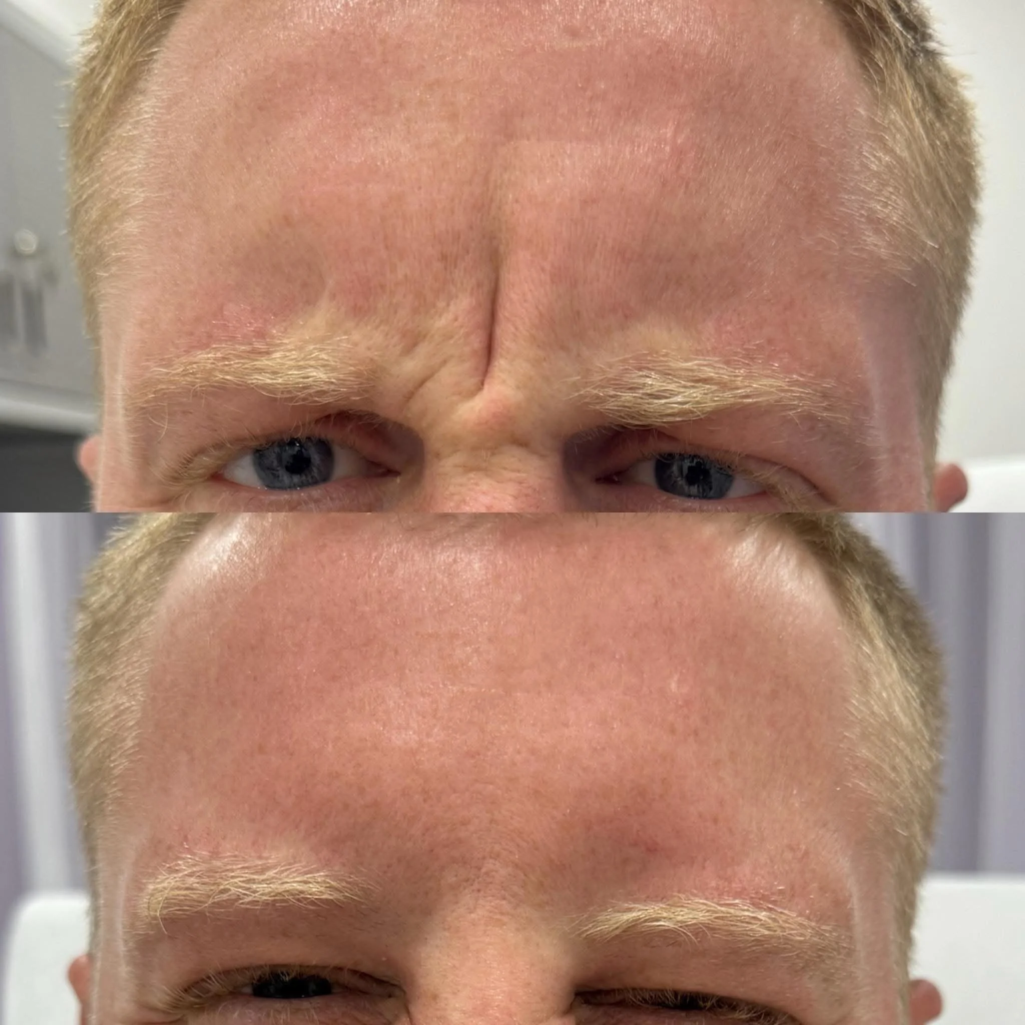 Close-up of a man's forehead showing before and after skincare treatment, with smoother skin in the after image.
