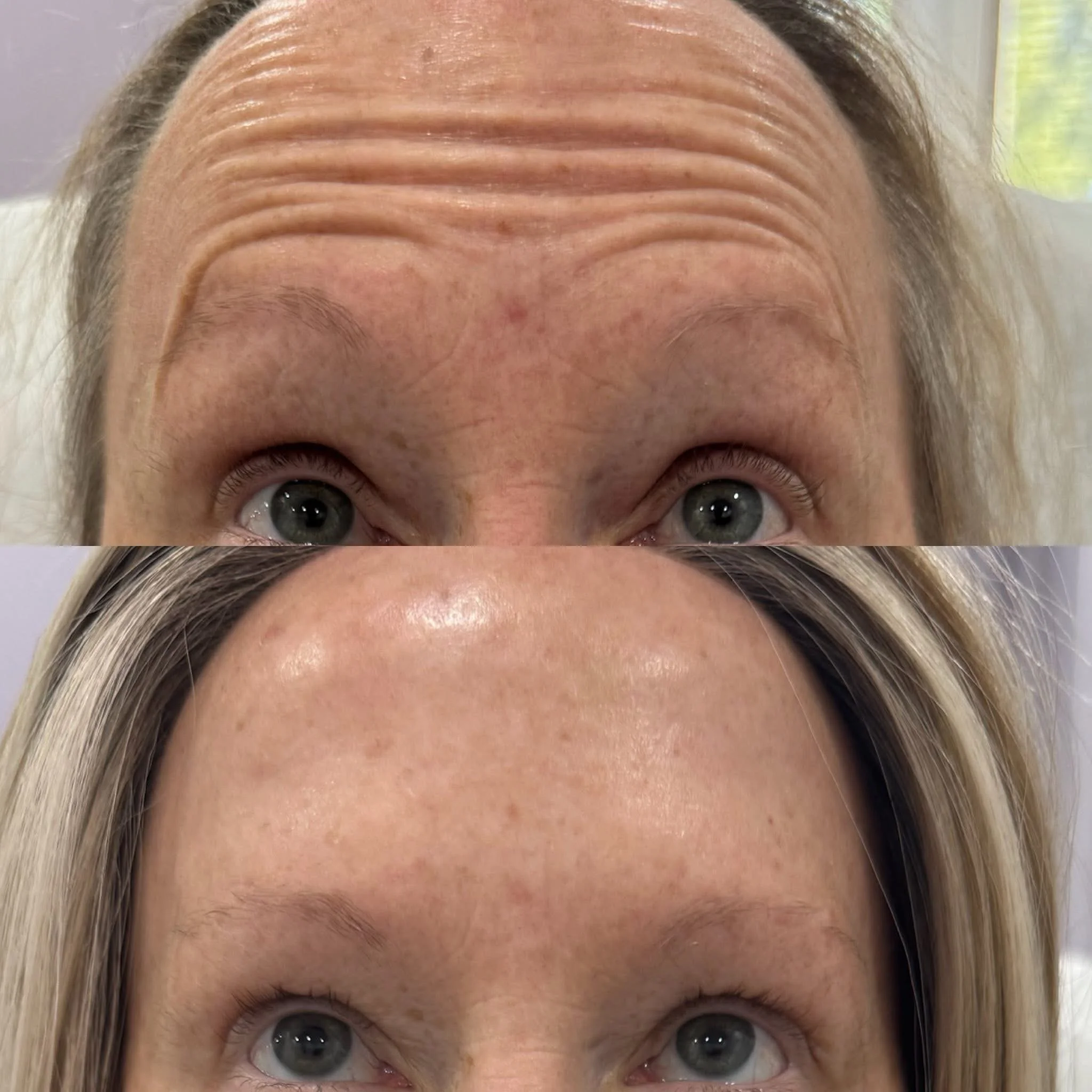 Before and after close-up images of a woman's forehead showing reduction in wrinkles and smoother skin.