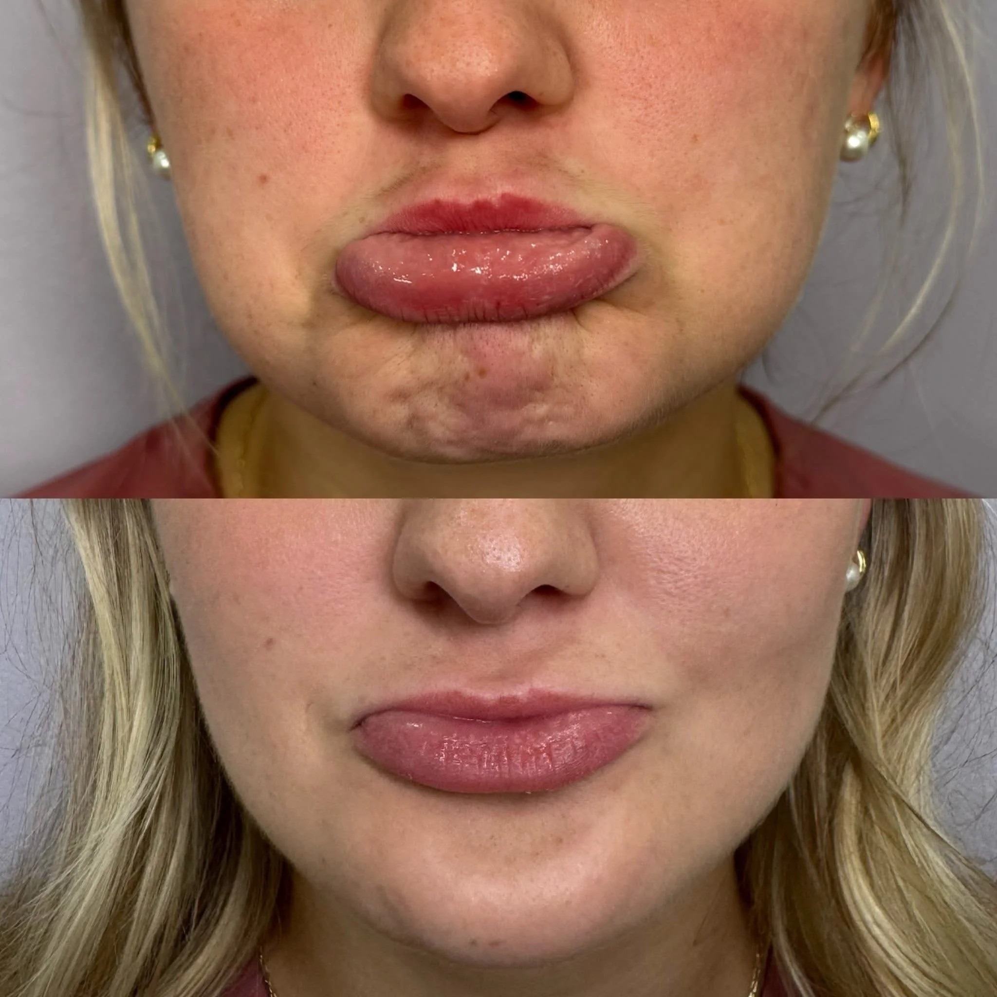 Before and after close-up photos of a woman's lips showing a change in size and shape.