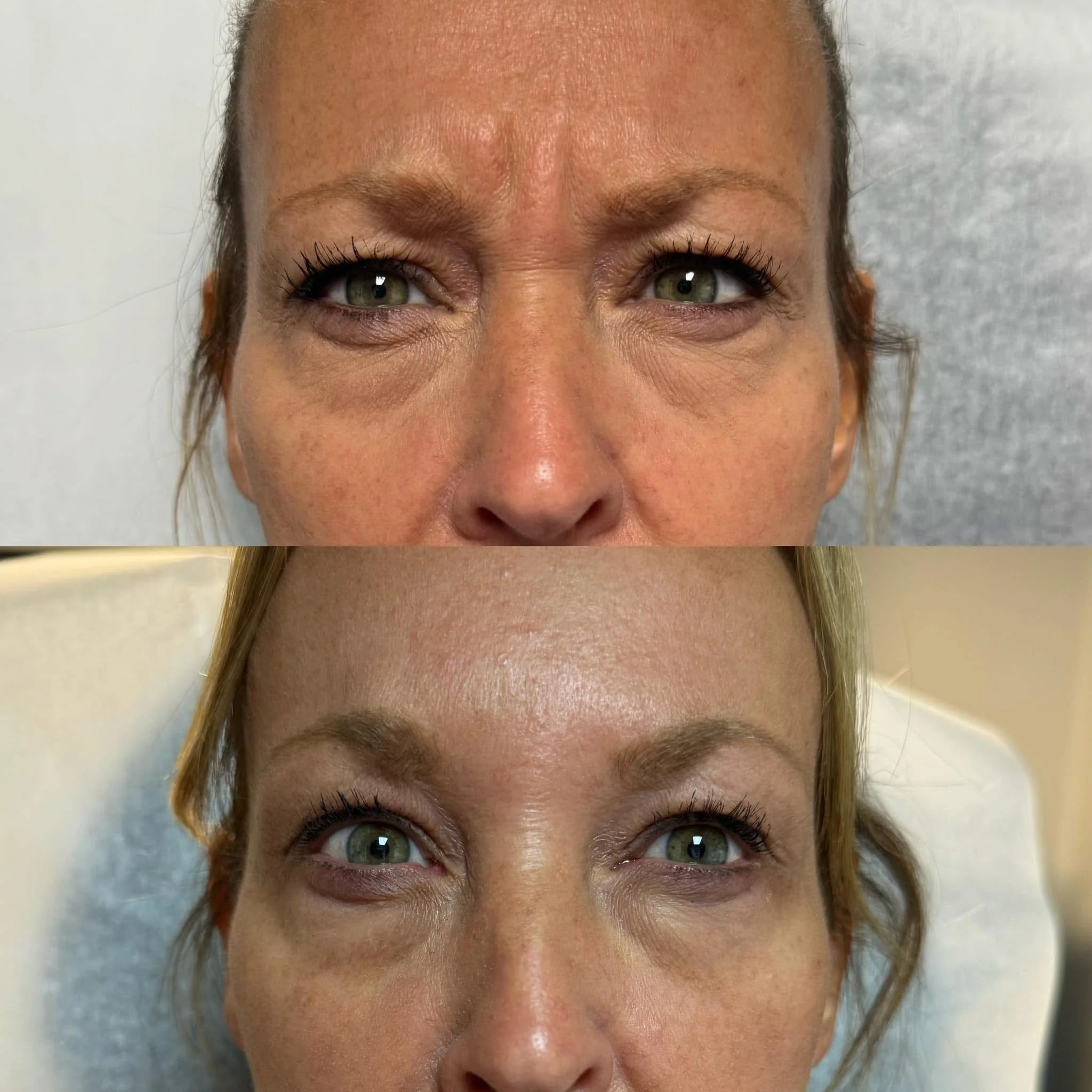 Comparison of a woman's face before and after cosmetic treatment, showing improved skin smoothness and reduced wrinkles around the eyes.