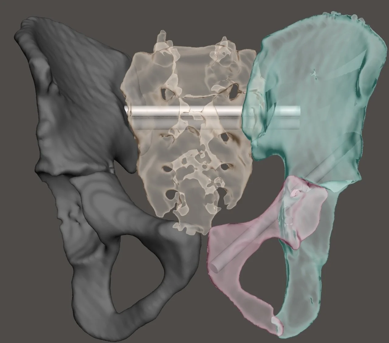 3D medical illustration of human pelvic bones, including ilium, ischium, and pubis, with a metallic rod passing through the pelvis.