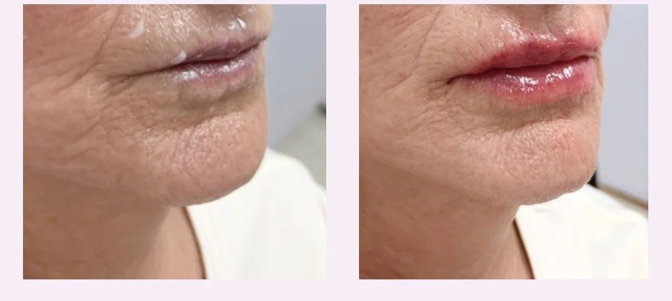 Before and after results following a lip enhancement treatment 