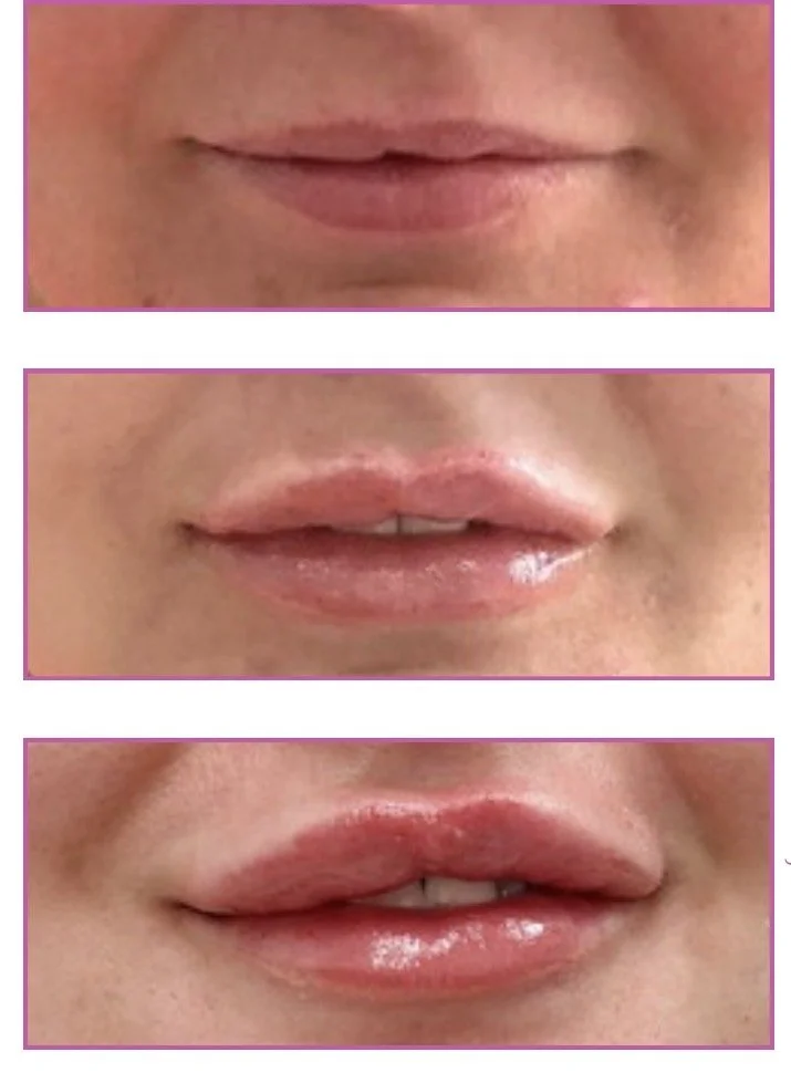 Before, immediately after and fully healed photo of client lips following lip enhancement treatment 
