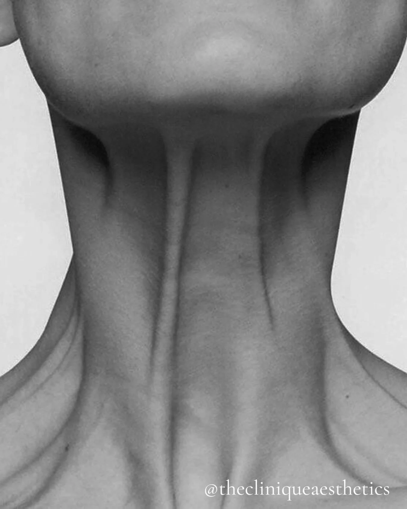 The Platysmal Muscle is a thin muscle in the neck that can become more active over time, sometimes showing as vertical neck bands or pulling of the skin

At @thecliniqueaesthetics, we offer complimentary consultations to assess whether treatment may 