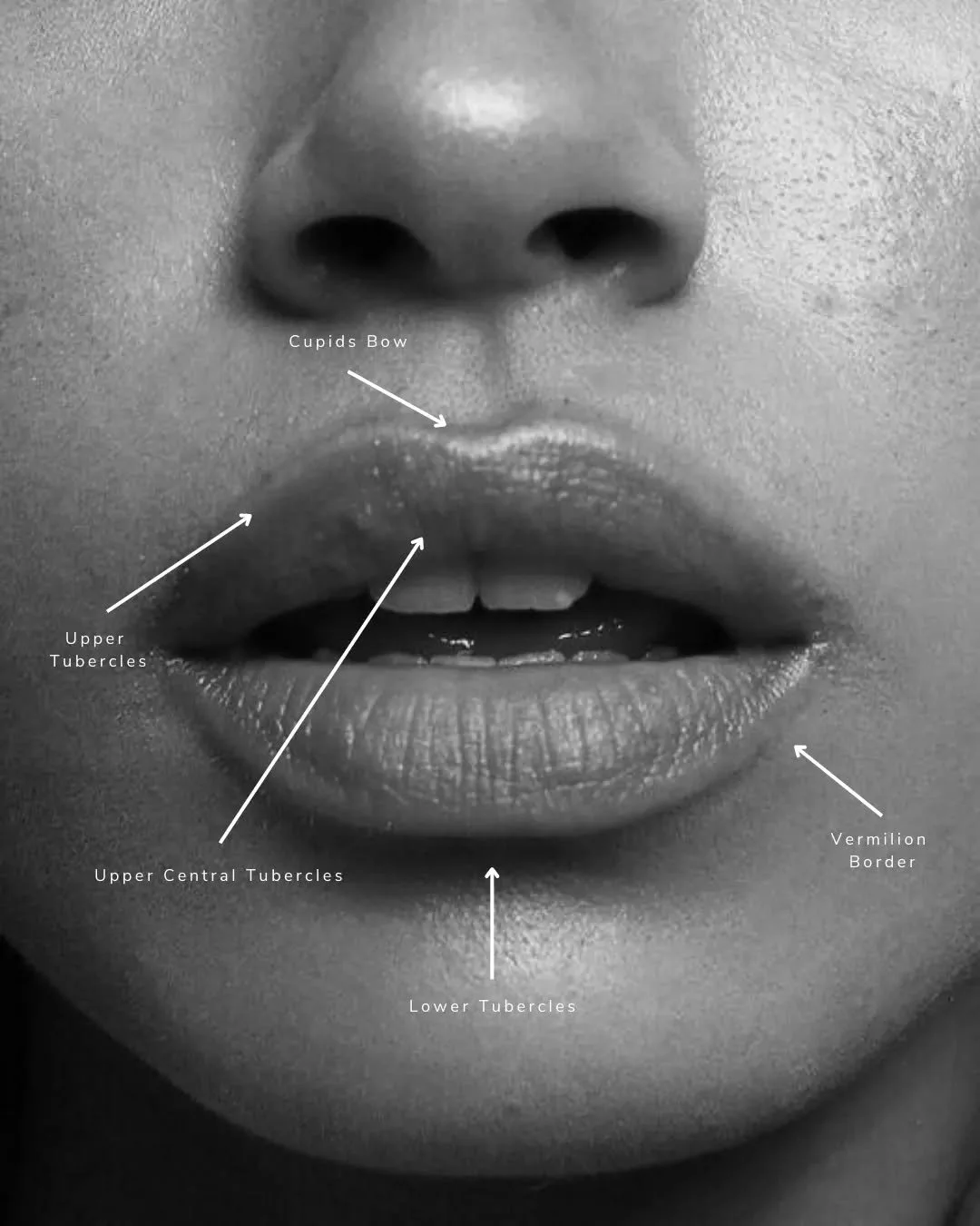 The lips are composed of complex anatomical landmarks - from the philtrum and vermilion border to the oral commissures and subtle shifts in volume.
Ageing can affect each of these areas differently, leading to flattening, dehydration, and loss of def