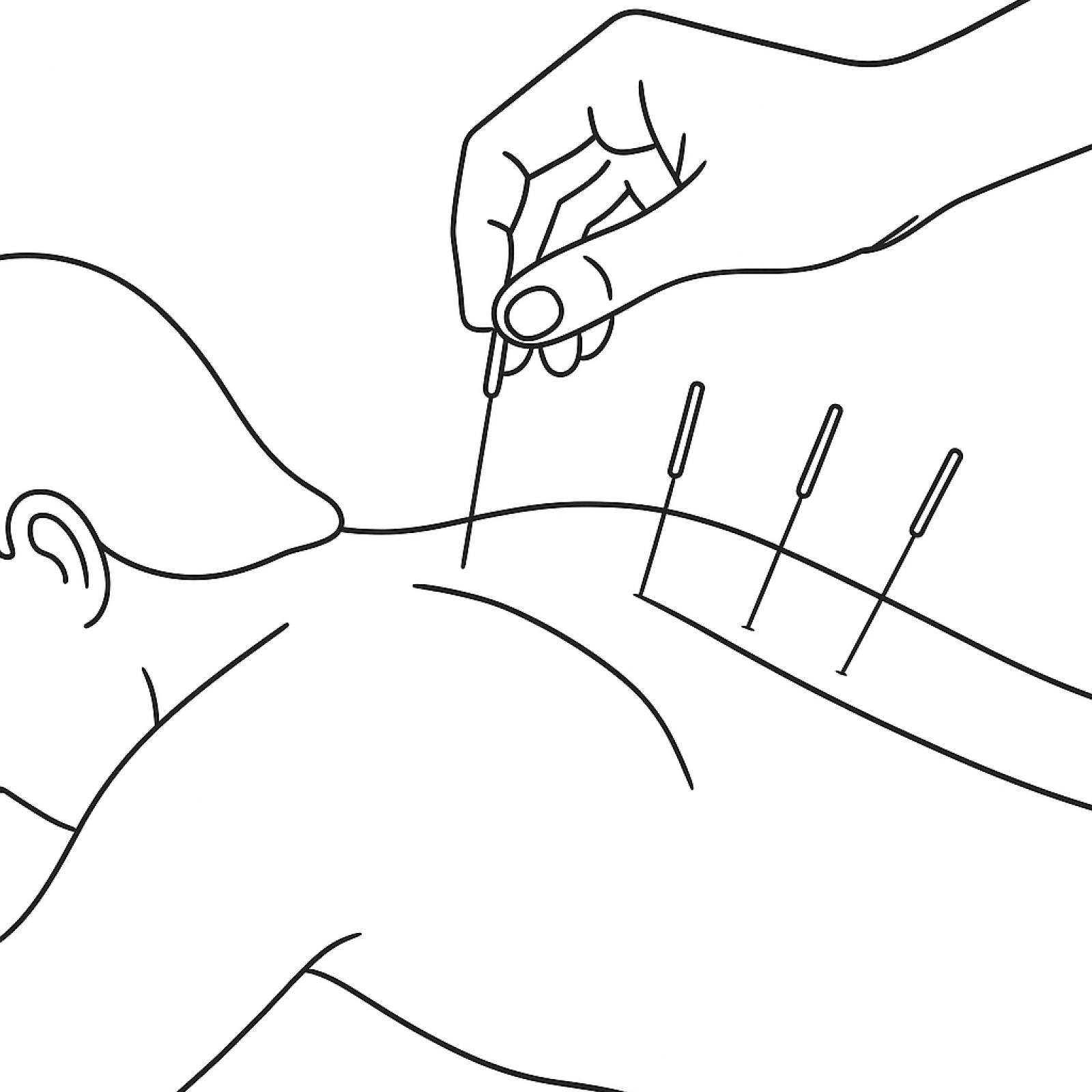 Outline of a person receiving acupuncture, with a practitioner inserting needles into their neck and shoulder area.