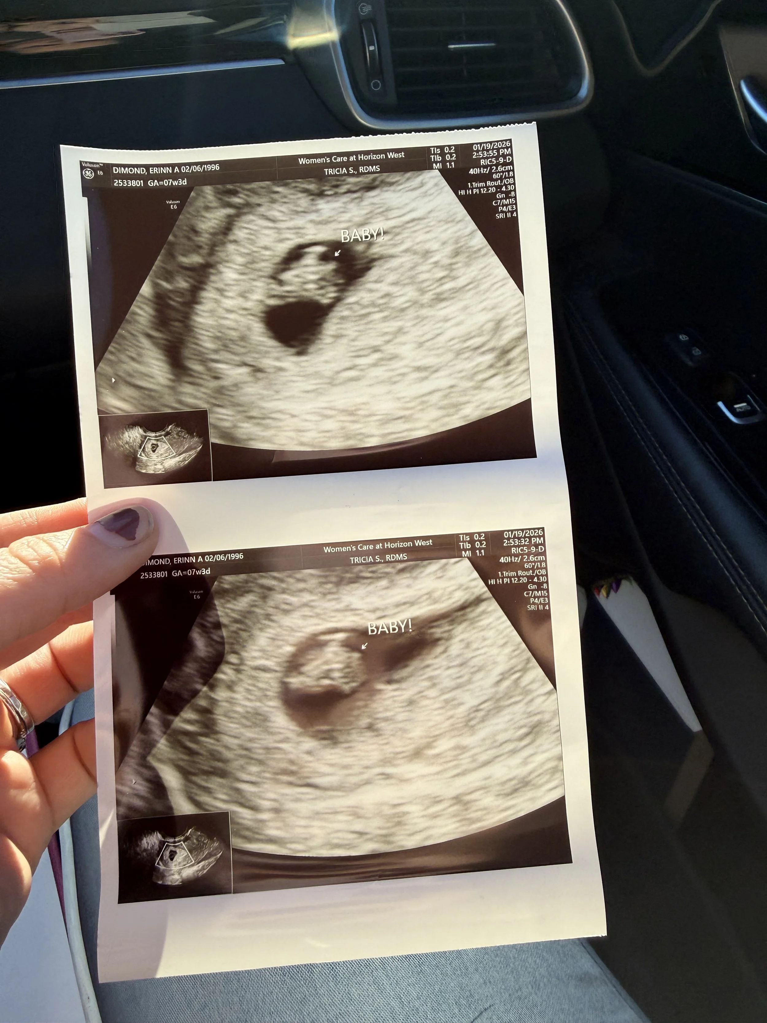 Four Things I Learned from my Early Pregnancy Miscarriage 