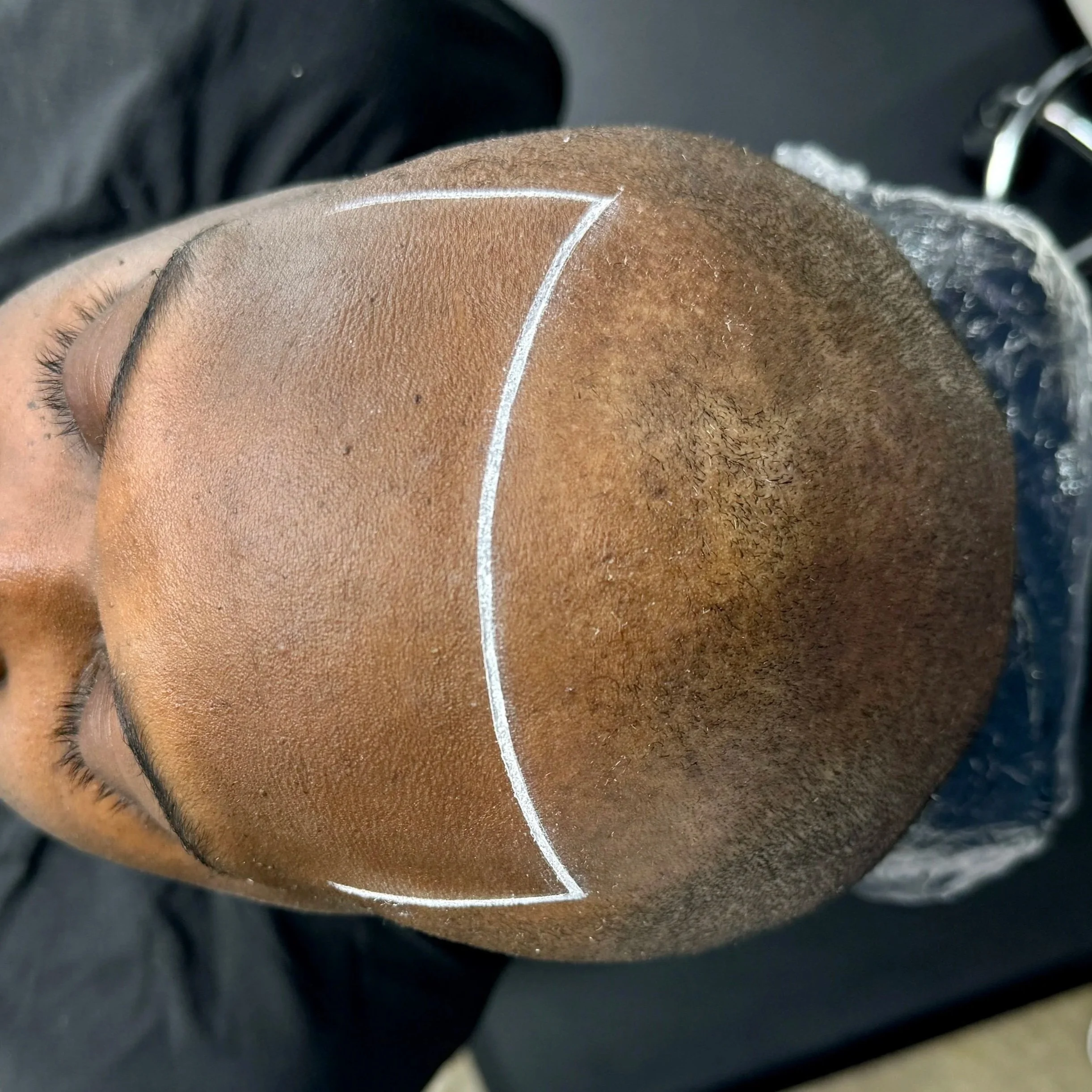 Top view of a person lying down with a marked area on their scalp, indicating a hair transplant or scalp treatment.