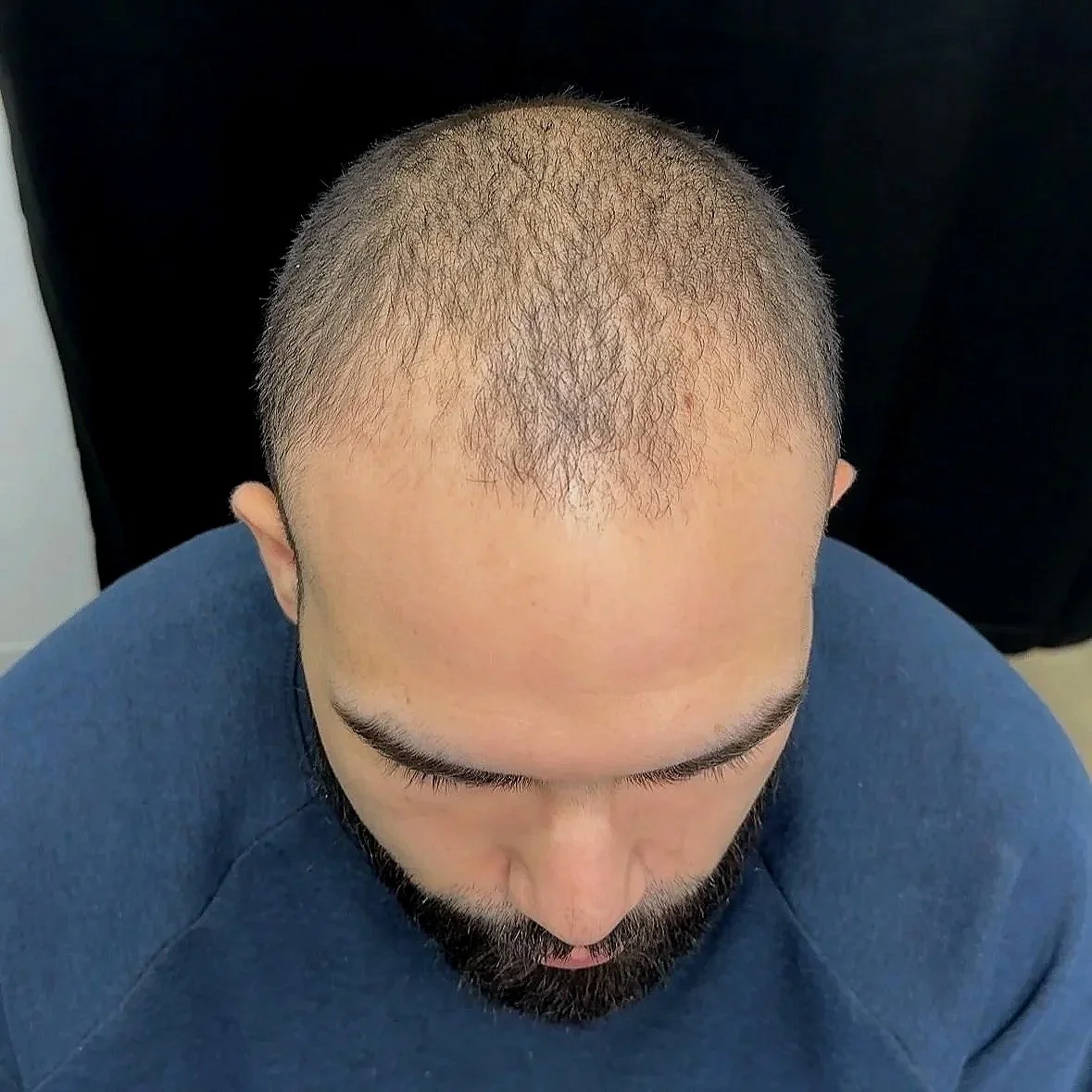 Top view of a man with a shaved head and a beard, wearing a blue shirt.