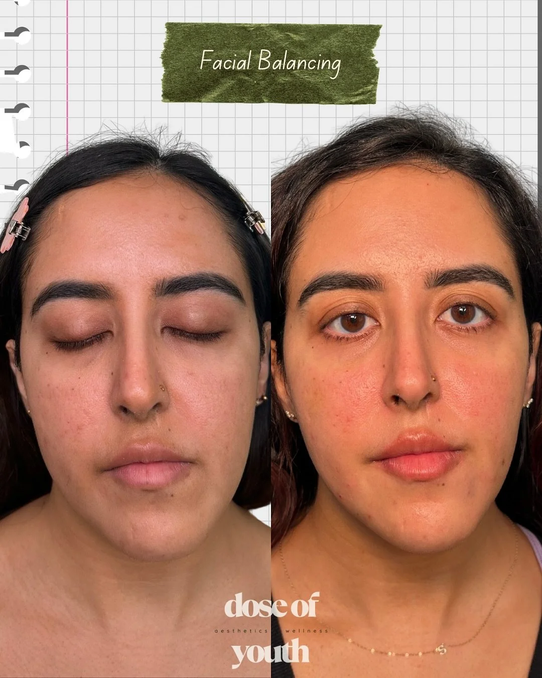 Facial balancing is a journey, not a one-time appointment.

We started this beautiful transformation back in April and slowly layered small, intentional amounts of filler over several months: cheeks, lips, chin, chin shadow, jawline, and neurotoxin.
