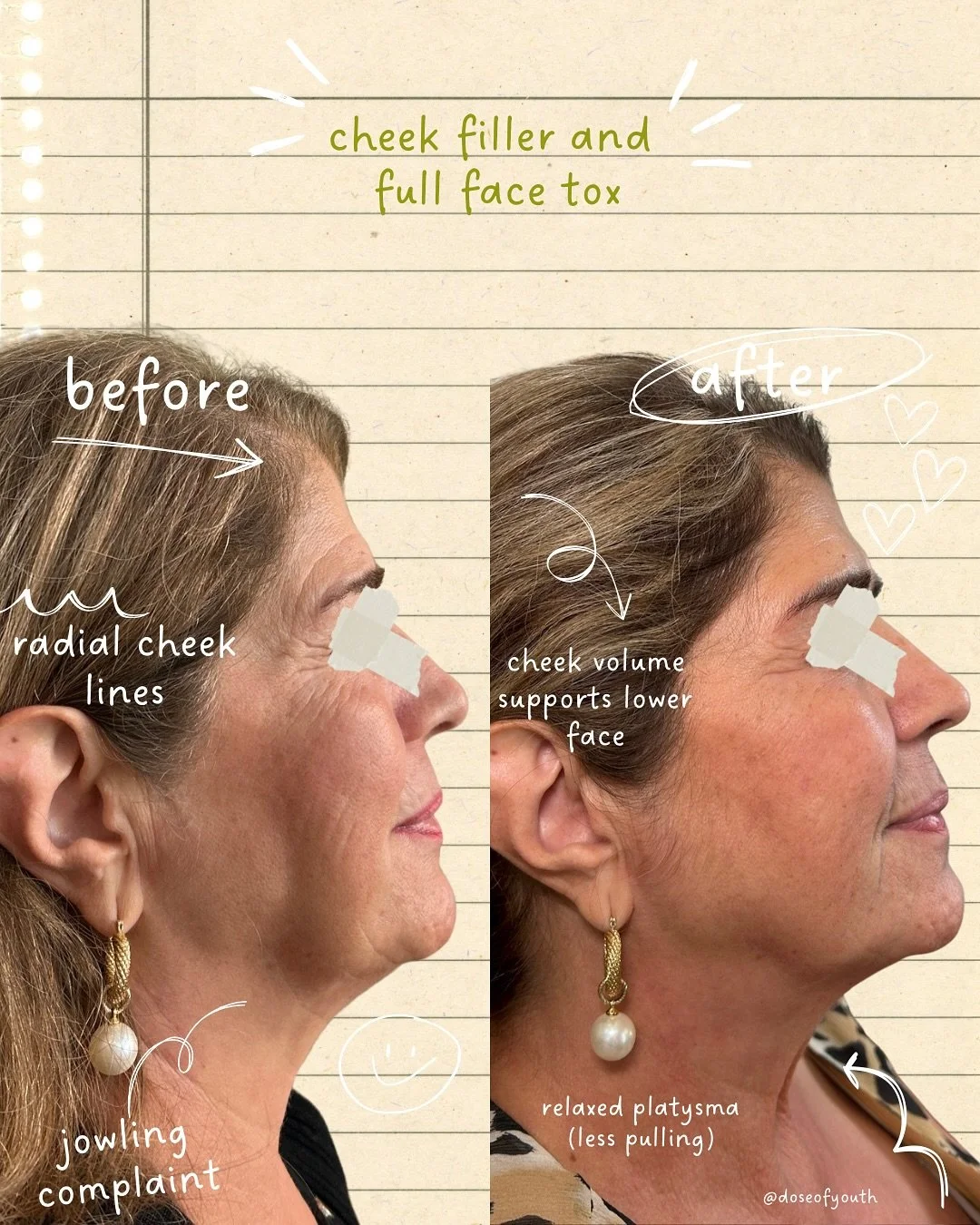 First-time tox + filler transformation ✨

This beautiful patient&rsquo;s main concern was lower face heaviness. By adding cheek filler for support and relaxing the muscles with full-face tox, we lifted and balanced her features &mdash; giving a light