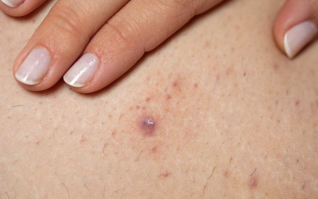 How to Prevent Ingrown Hairs