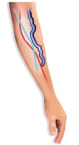 Illustration of a leg showing varicose veins in the calf with red and blue lines indicating blood flow.