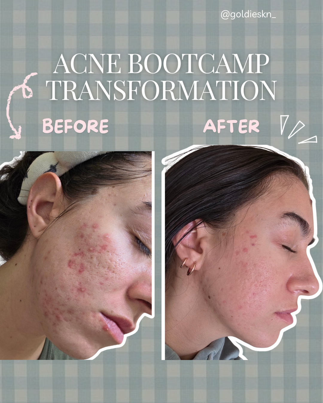 Acne Bootcamp: How We Clear Acne Step-by-Step (Real Client Results)