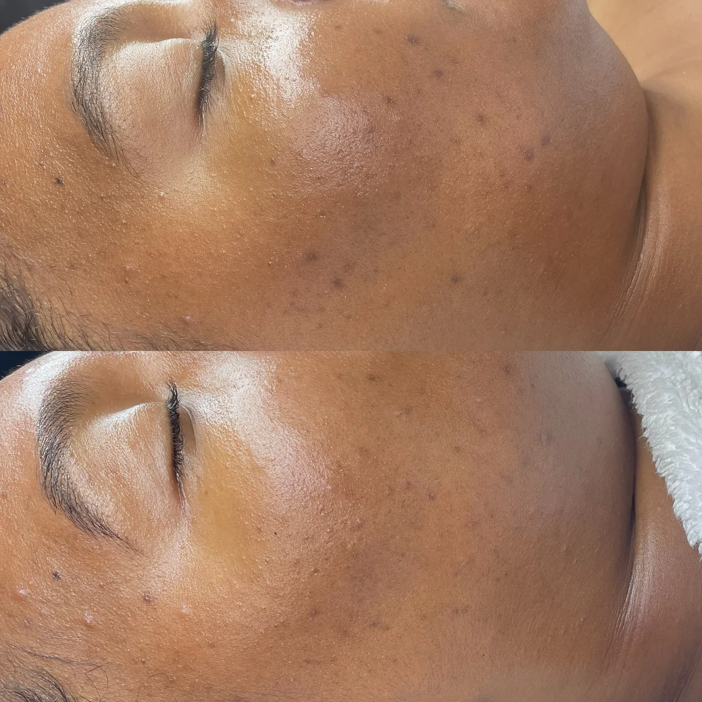 Skincare is a journey and results are always worth the commitment ✨ 

1st facial vs 2nd facial 💕

-
-
-
📞 876-796-7001 
📧 info@sharikaydenisebeauty.com 
🔗 www.sharikaydenisebeauty.com 
🔗 https://sharikaydenisebeauty.as.me

-
#sharikaydenisebeaut
