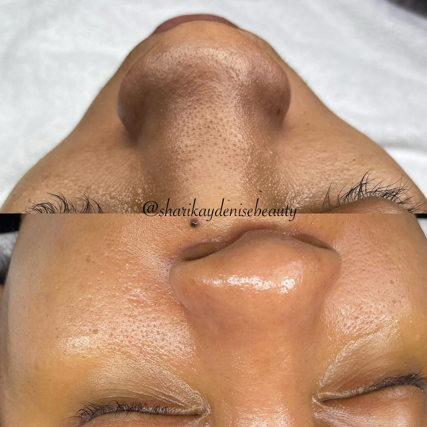 No more buildup 😍
-
-
#sharikaydenisebeauty #skinbyshari #sdb #facialsinjamaica #skincarejamaica