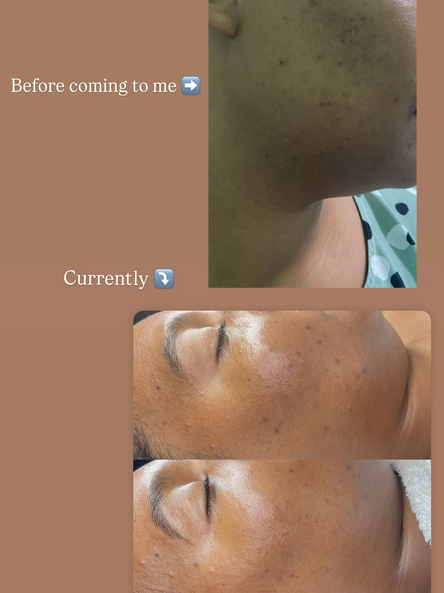 When you invest in consistent facials and the right homecare, your skin shows up for you 🖤
-
-
#sharikaydenisebeauty #skinbyshari #sdb #facialsinjamaica #skincarejamaica #dermaplaningjamaica #acnefacialjamaica #hyperpigmentationfacialjamaica