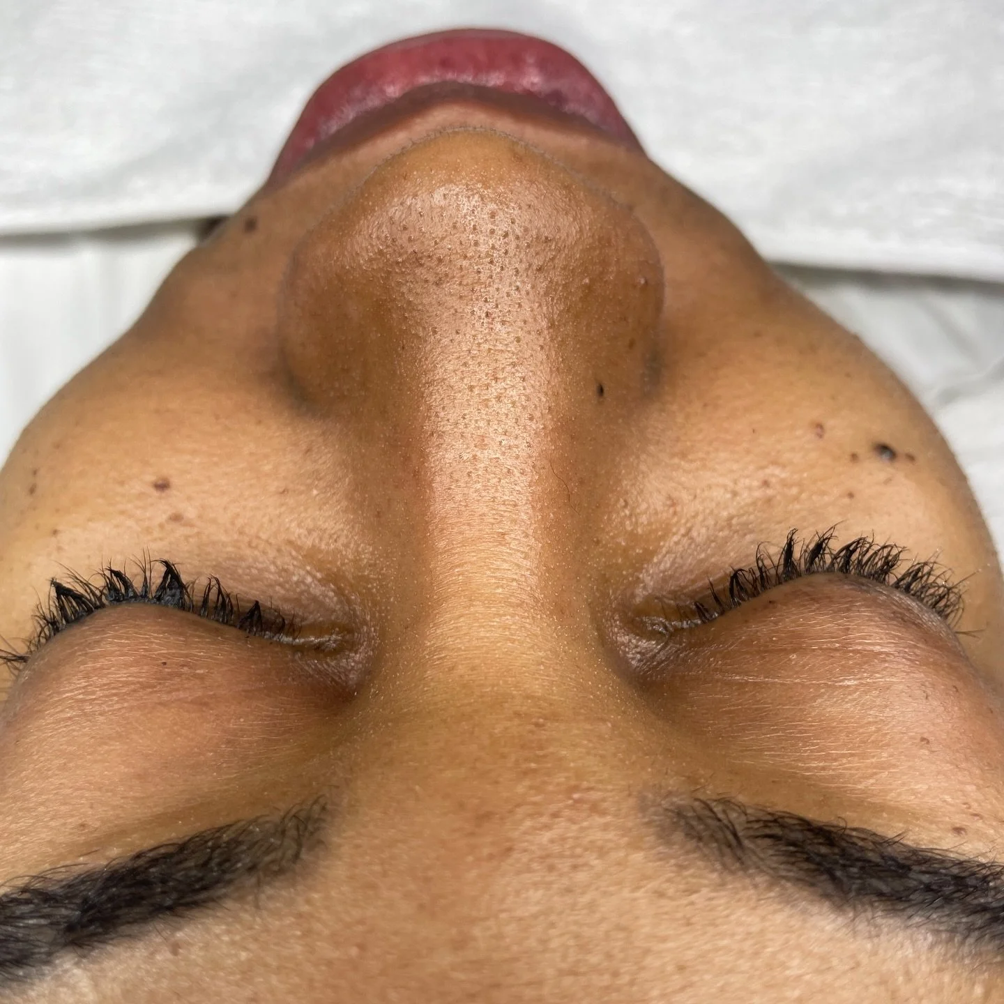 I love a good extractions session. Swipe for clean pores 😍✨