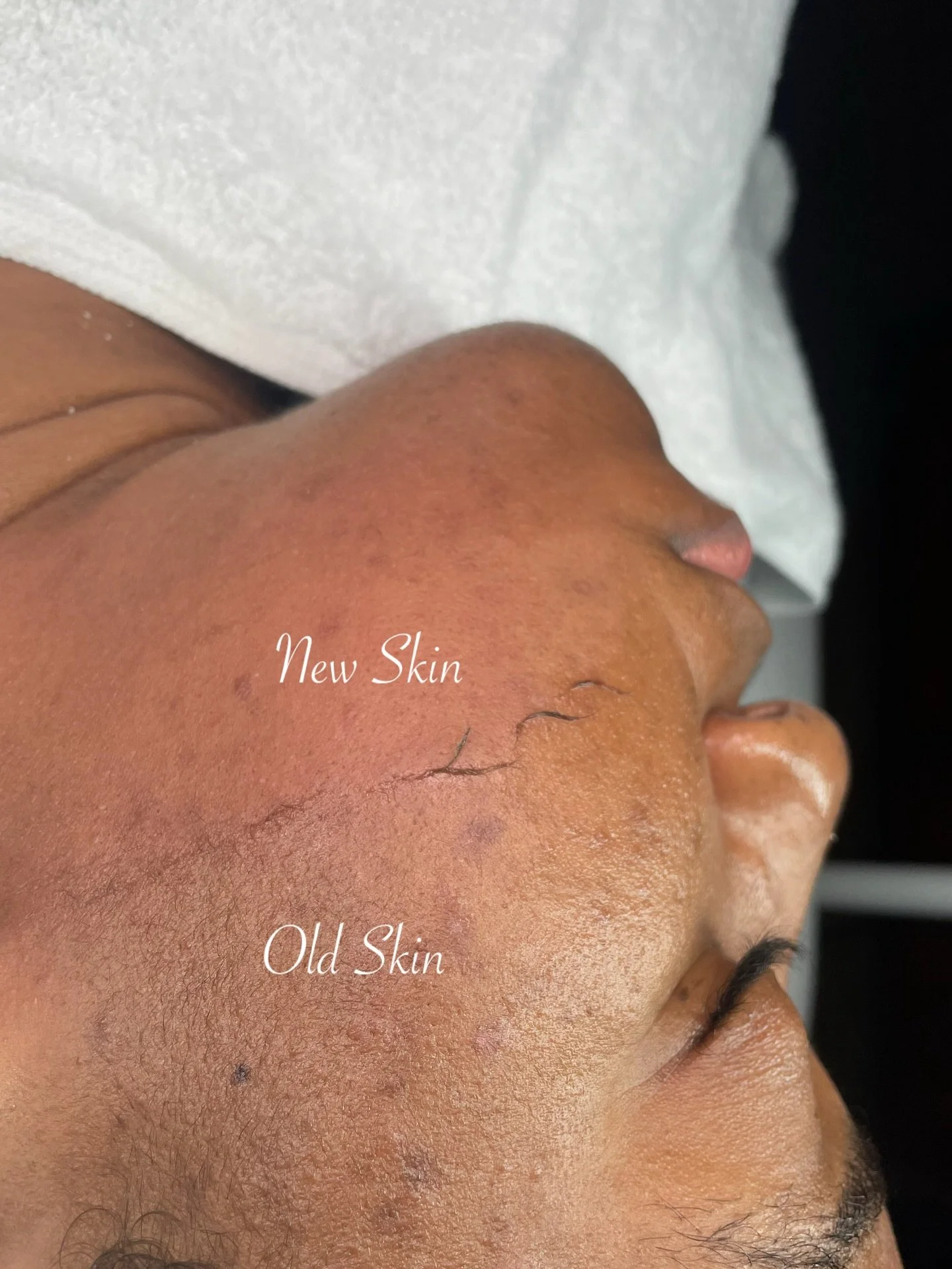 New year, refreshed skin 🙌🏾

Dermaplaning is the ultimate reset; refining texture, enhancing glow, and allowing your skincare to perform at its best. 

-
-
#sharikaydenisebeauty #skinbyshari #sdb #facialsinjamaica #dermaplaningjamaica