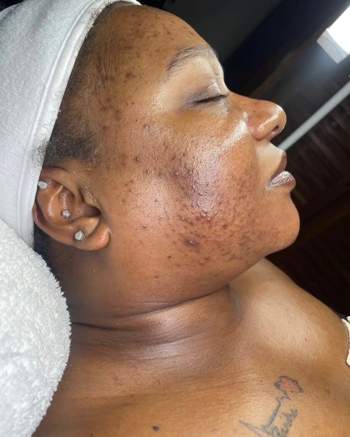 May 1st vs May 30th 😍🔥

My lovely client went on a trip outside of the country and unfortunately, the environment took a toll on her skin. 

I recommended we switched from our regular Tier 1 Facials and do a Tier 2 Oxygen Treatment instead. 

The O