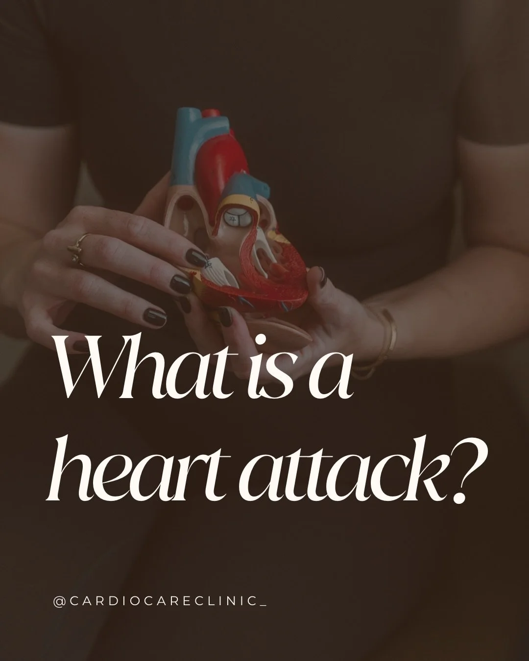A heart attack happens when blood flow to part of the heart muscle is blocked or significantly reduced.

The coronary arteries supply the heart muscle with oxygen-rich blood. When blood flow through one of these arteries is reduced or blocked &mdash;