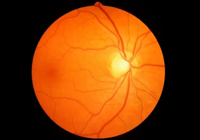 🟡 [GLP-1 작용제와 돌발 시력 상실: 전 세계 체중 감량 약물 붐 속에서 나타나는 새로운 위험 신호]