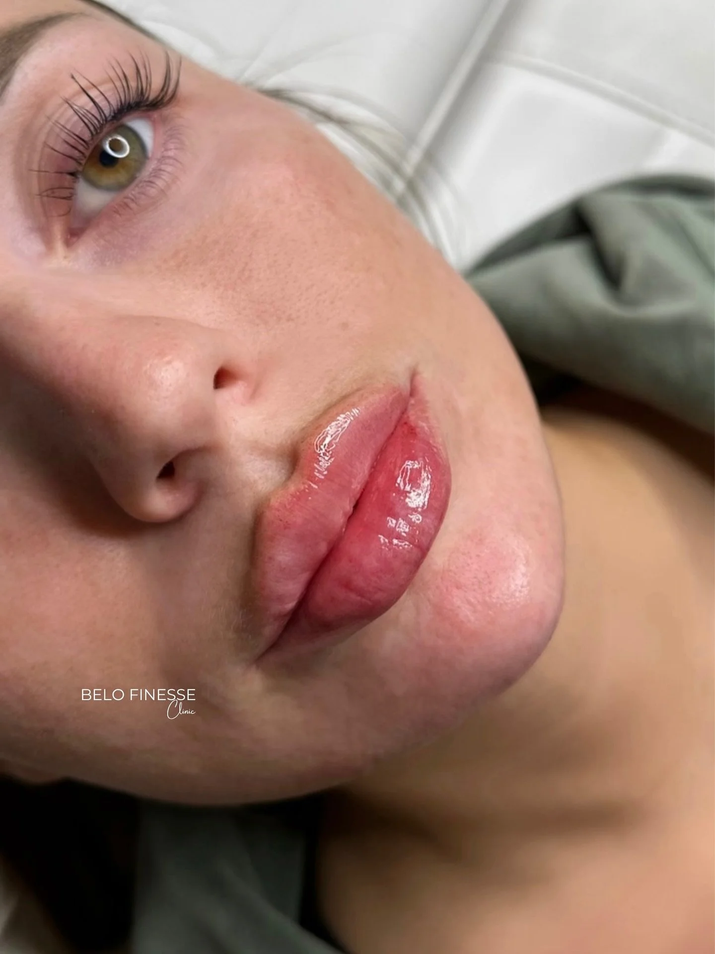 𝐋𝐢𝐩𝐬 &amp; 𝐂𝐡𝐢𝐧 𝐢𝐧 𝐚𝐜𝐭𝐢𝐨𝐧 💉

Denna fina kund hade migrerad filler i b&aring;de l&auml;ppar och haka ifr&aring;n olika behandlare &ouml;ver flera &aring;rs tid. 
Vi beslutade oss f&ouml;r att t&ouml;mma all filler &amp; bygga upp igen