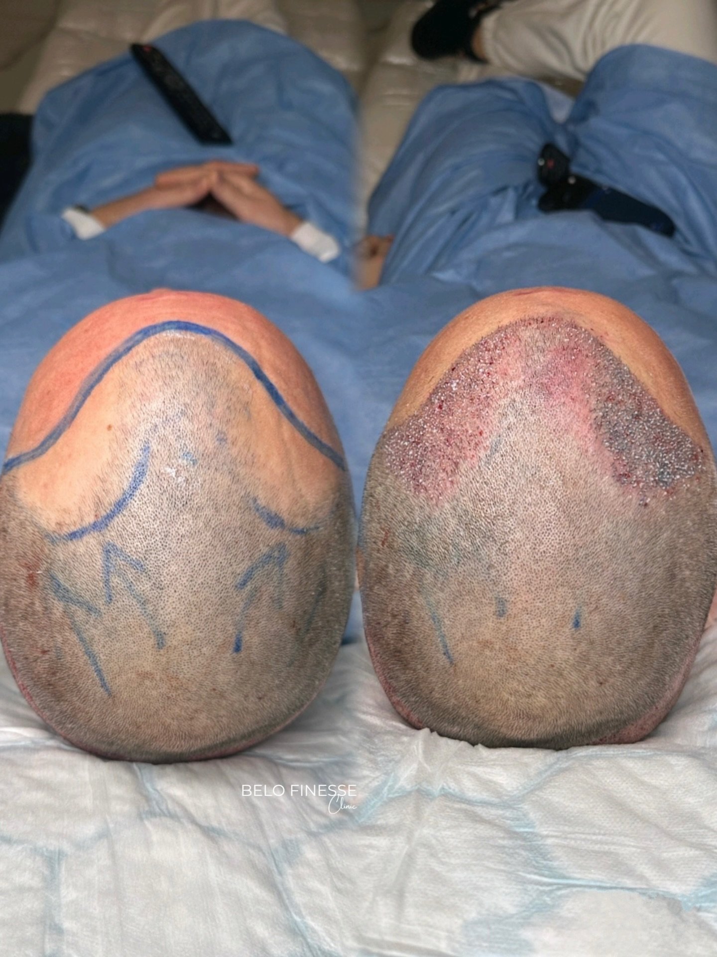 𝟐𝟓𝟎𝟎 𝐠𝐫𝐚𝐟𝐭𝐬 𝐓𝐫𝐚𝐧𝐬𝐩𝐥𝐚𝐧𝐭𝐞𝐝 🫡

G&aring;r du i tankarna om att genomg&aring; en H&aring;r Transplantation? 
Boka en kostnadsfri konsultation hos oss! 
Vi besvarar alla fr&aring;gor &amp; funderingar, oavsett om du undrar &ouml;ver 