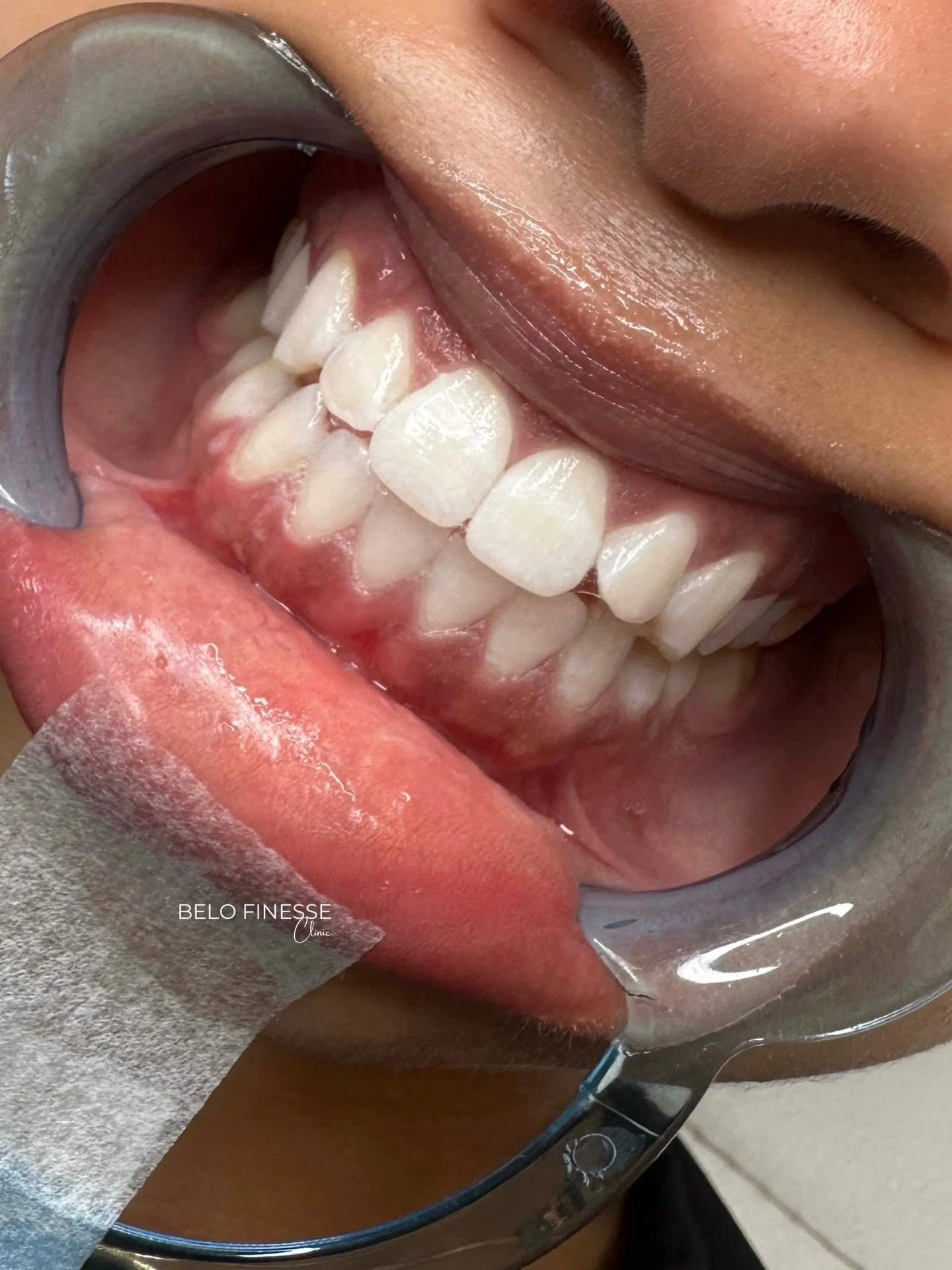 𝟒𝟎 𝐦𝐢𝐧𝐮𝐭𝐞𝐬 𝐓𝐞𝐞𝐭𝐡 𝐖𝐡𝐢𝐭𝐞𝐧𝐢𝐧𝐠 🦷

Uppt&auml;ck v&aring;r professionella tandblekning som g&ouml;r skillnad redan efter f&ouml;rsta behandlingen! 💫

Boka din tid hos oss online 📲 

𝓥𝓪𝓻𝓶𝓽 𝓿&auml;𝓵𝓴𝓸𝓶𝓷𝓪!

📲 +4672007950