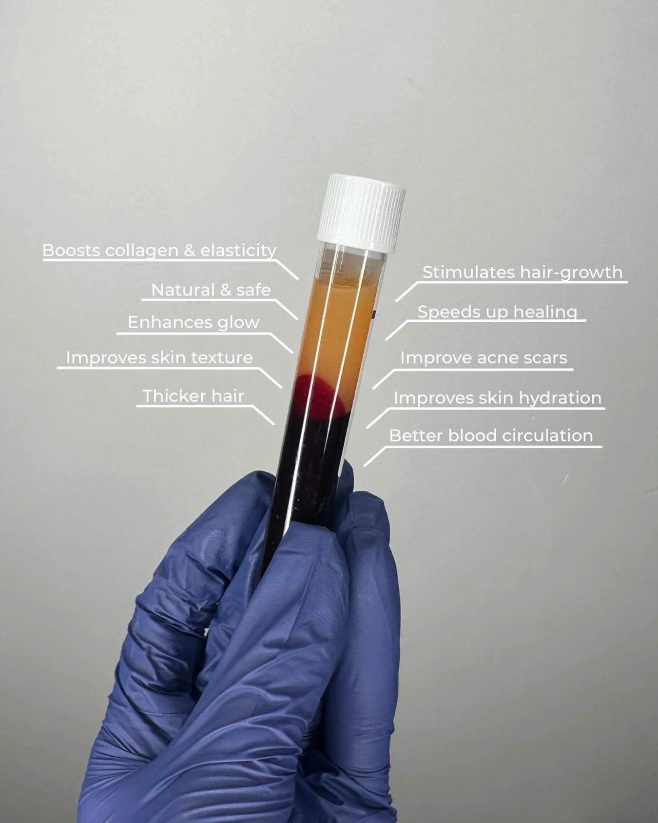 𝐃𝐨 𝐰𝐞 𝐧𝐞𝐞𝐝 𝐭𝐨 𝐠𝐢𝐯𝐞 𝐲𝐨𝐮 𝐚𝐧𝐲 𝐨𝐭𝐡𝐞𝐫 𝐫𝐞𝐚𝐬𝐨𝐧? 💫

💉 Just nu: Boka din PRP-behandling via Bokadirekt f&ouml;r ansikte eller h&aring;r (valfritt) f&ouml;r endast 1499:- (ord pris 2199:-) 💫

⚠️ Obs: Gl&ouml;m inte att boka di