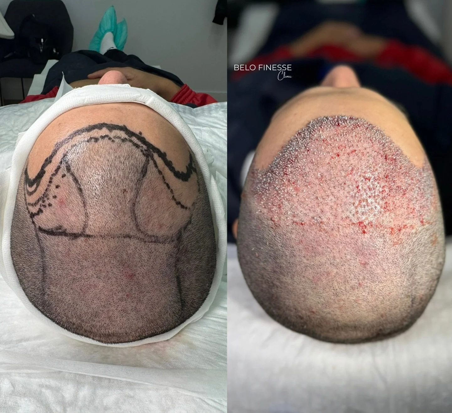 Before &amp; After with 2500 grafts 💫

Boka din konsultation enkelt online via belofinesse.bokadirekt.se eller ring till oss p&aring; 0720079501 📲

𝐆𝐞𝐭 𝐛𝐨𝐨𝐤𝐞𝐝 𝐢𝐧! 👩🏼&zwj;⚕️

📲 +46720079501
📆 Belofinesse.bokadirekt.se
📩 Belofinesse@g